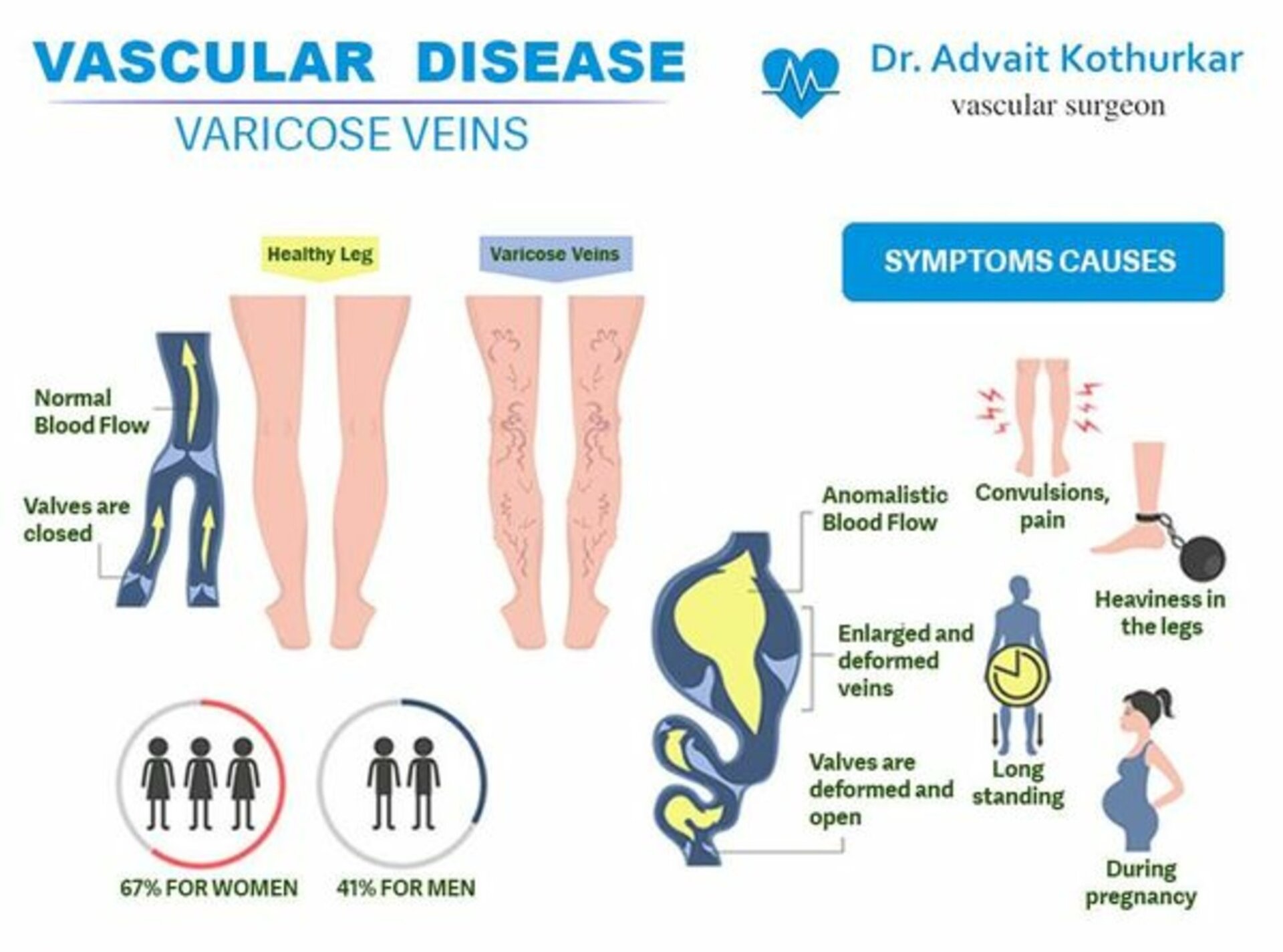 Varicose Veins | Dr. Advait Kothurkar