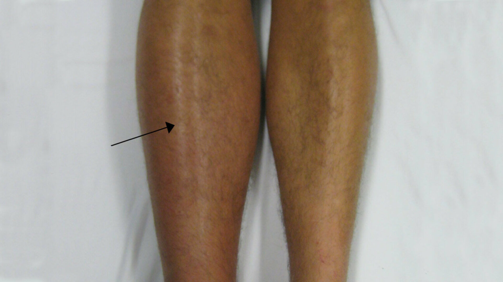 Management of Swollen Legs/DVT | Dr. Advait Kothurkar