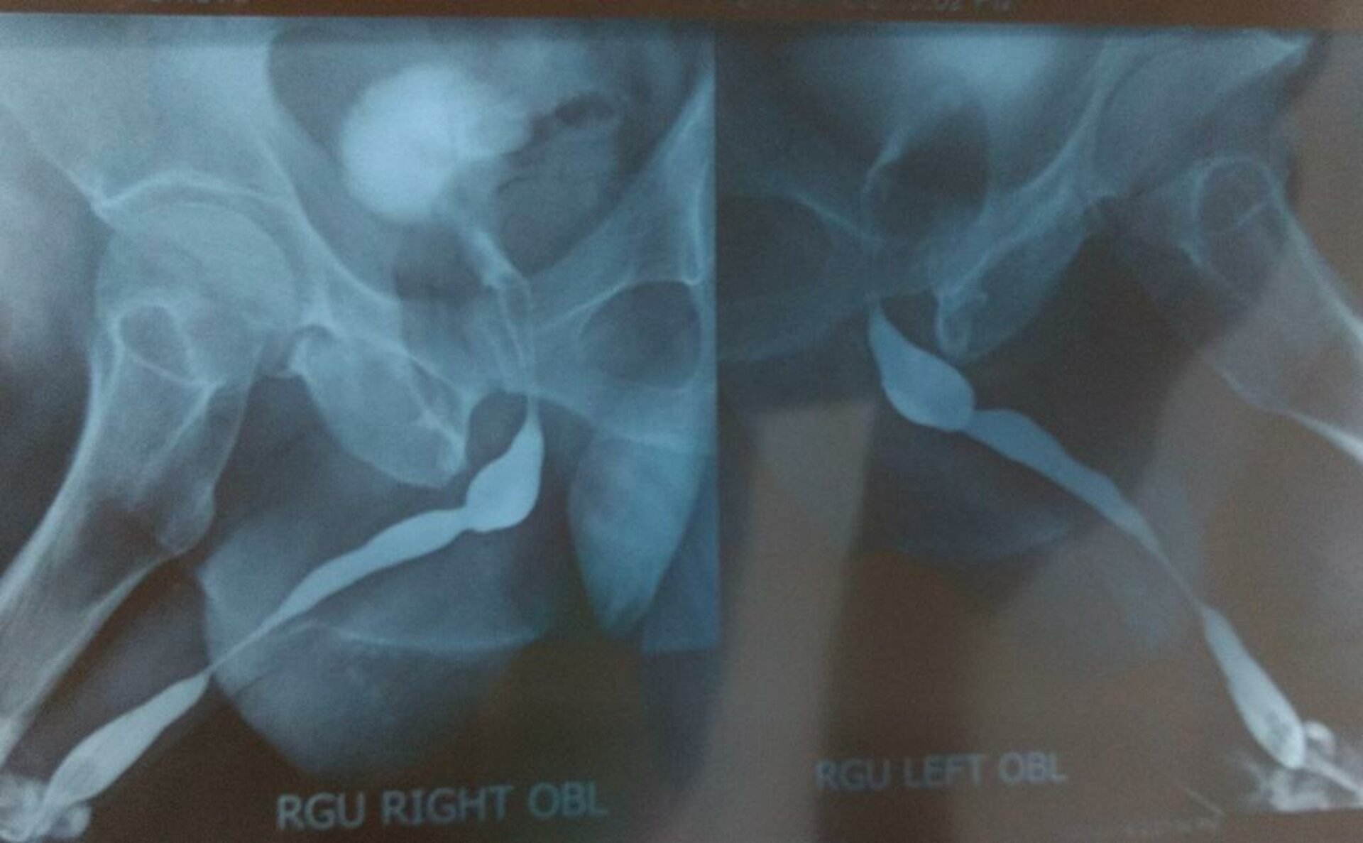 Difficulty in Urinating Treatment by Buccal Mucosa Graft Urethroplasty | Dr. Bhoopat Bhati