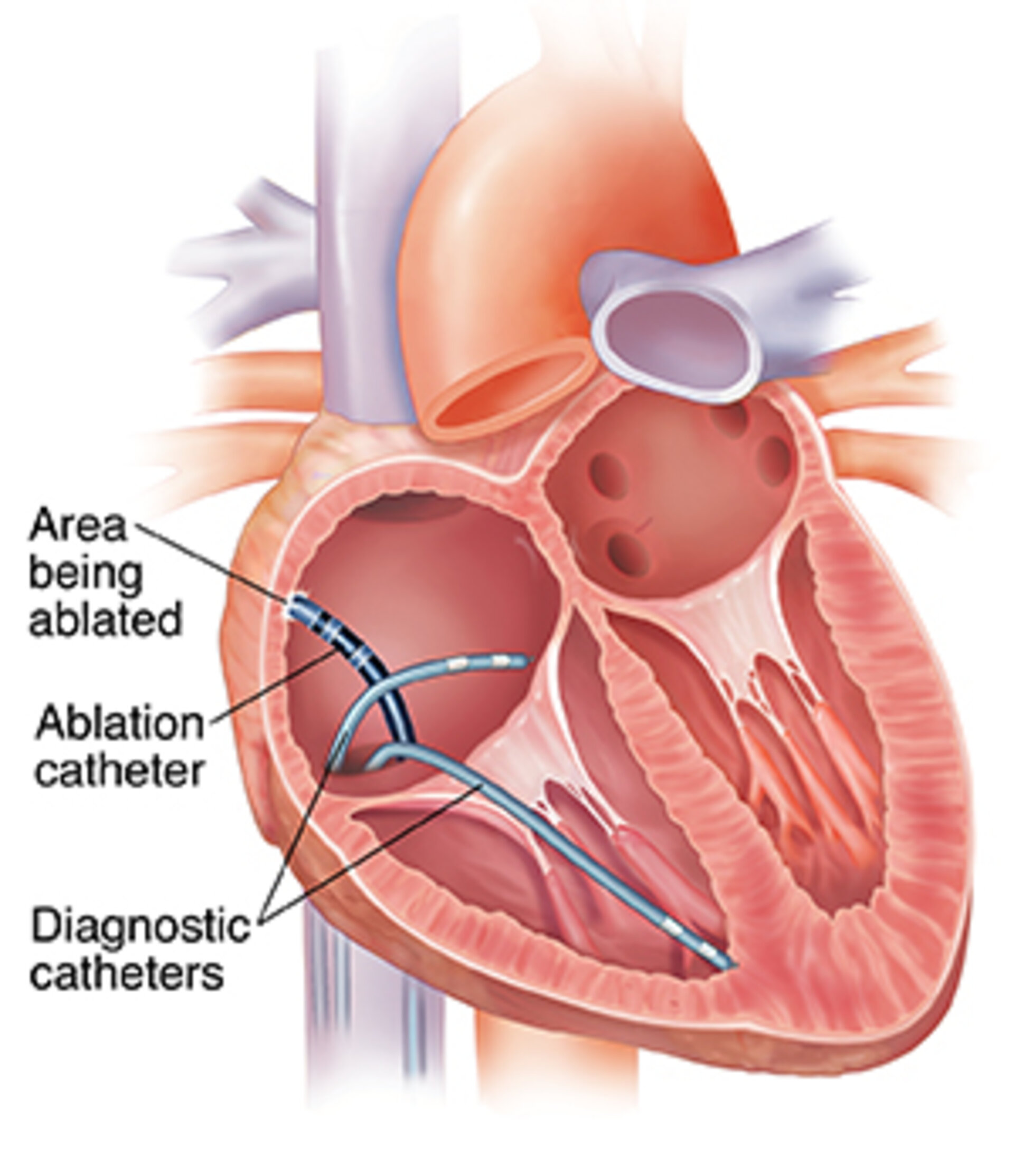Cardiac Ablation