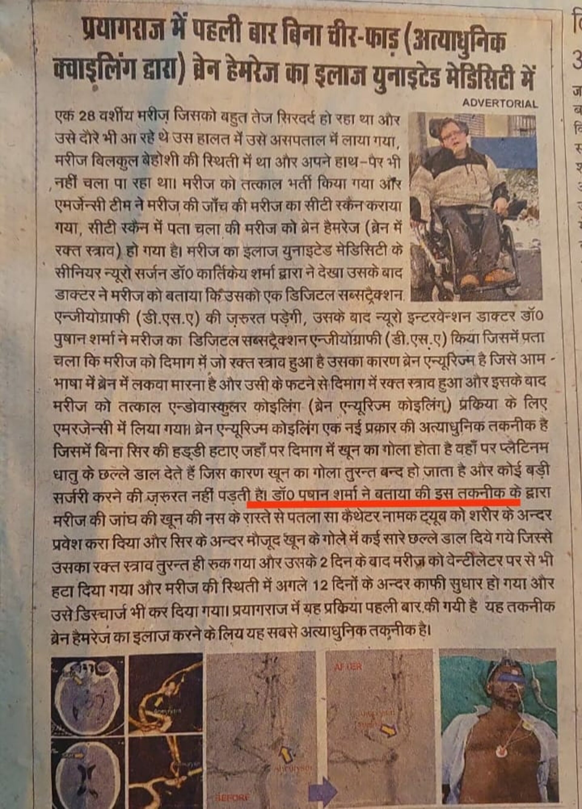 Non surgical treatment of Brain Hemorrage in Prayagraj - Dr. Pushan a