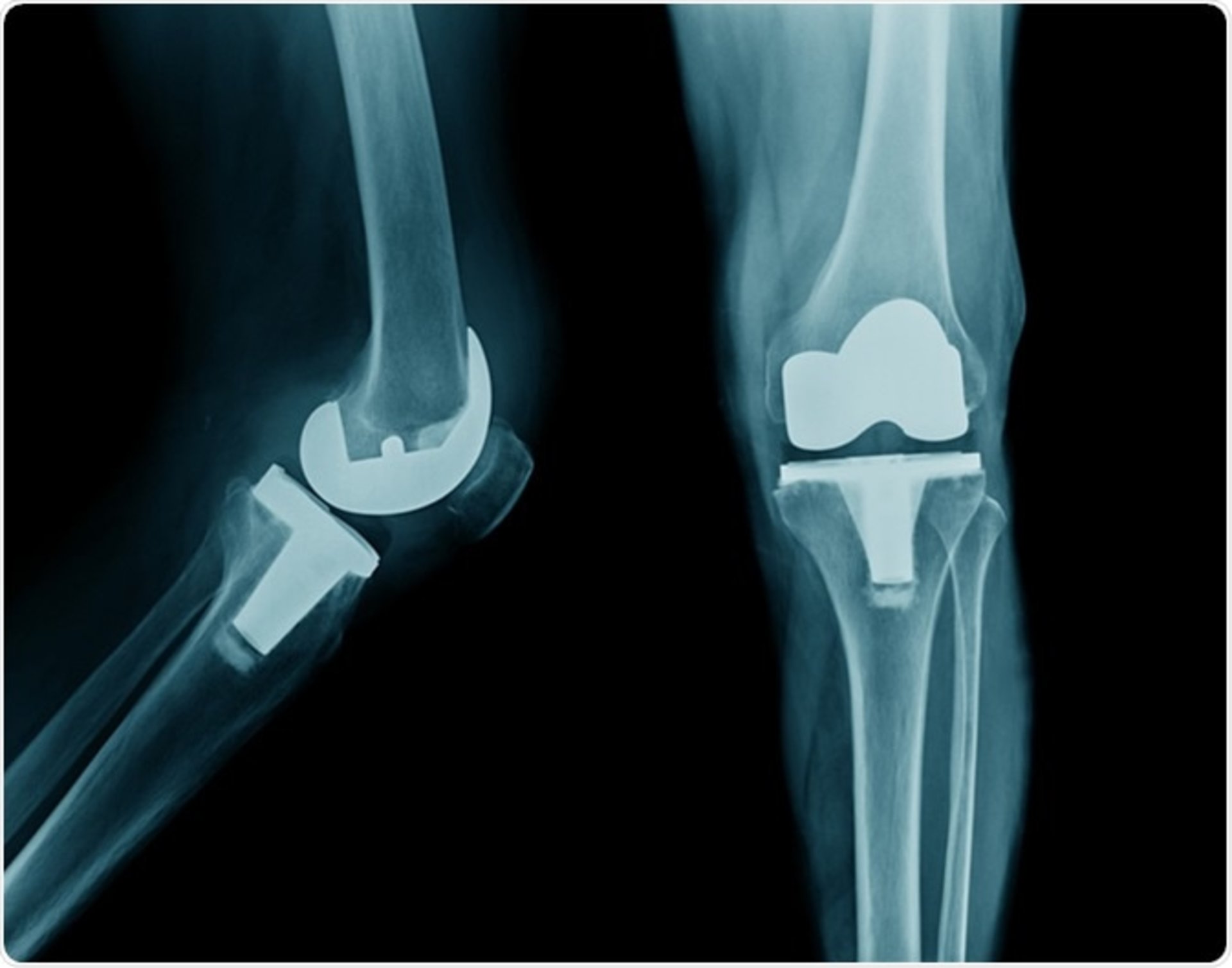 Total Knee Replacment by Dr. Sandeep Chauhan