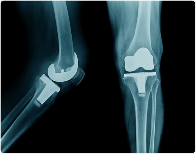 FAQs on Total Knee Replacement