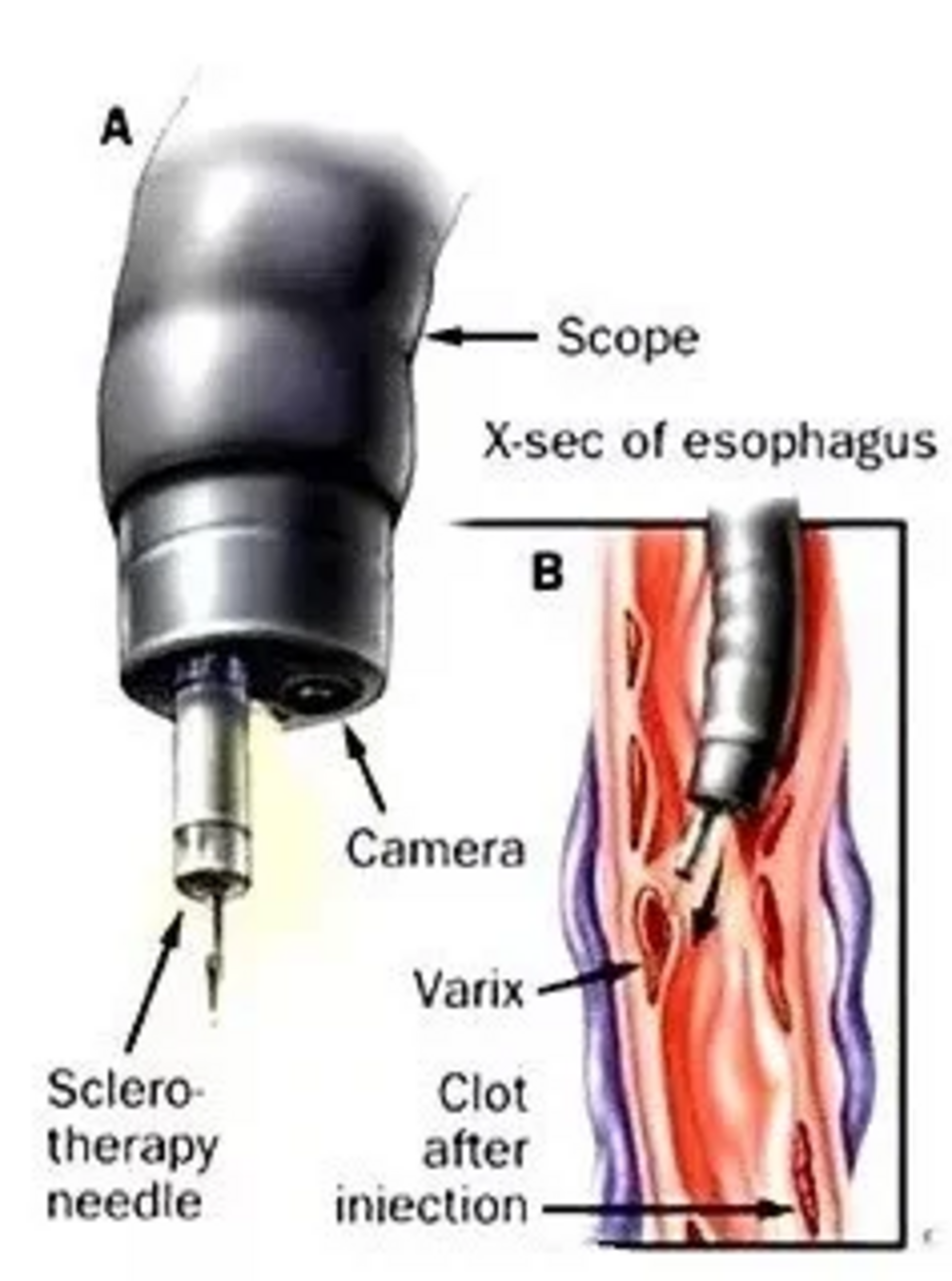 Injection Sclerotherapy and Glue Injection at RL Gastrocare | Dr. Rupesh Lunkad