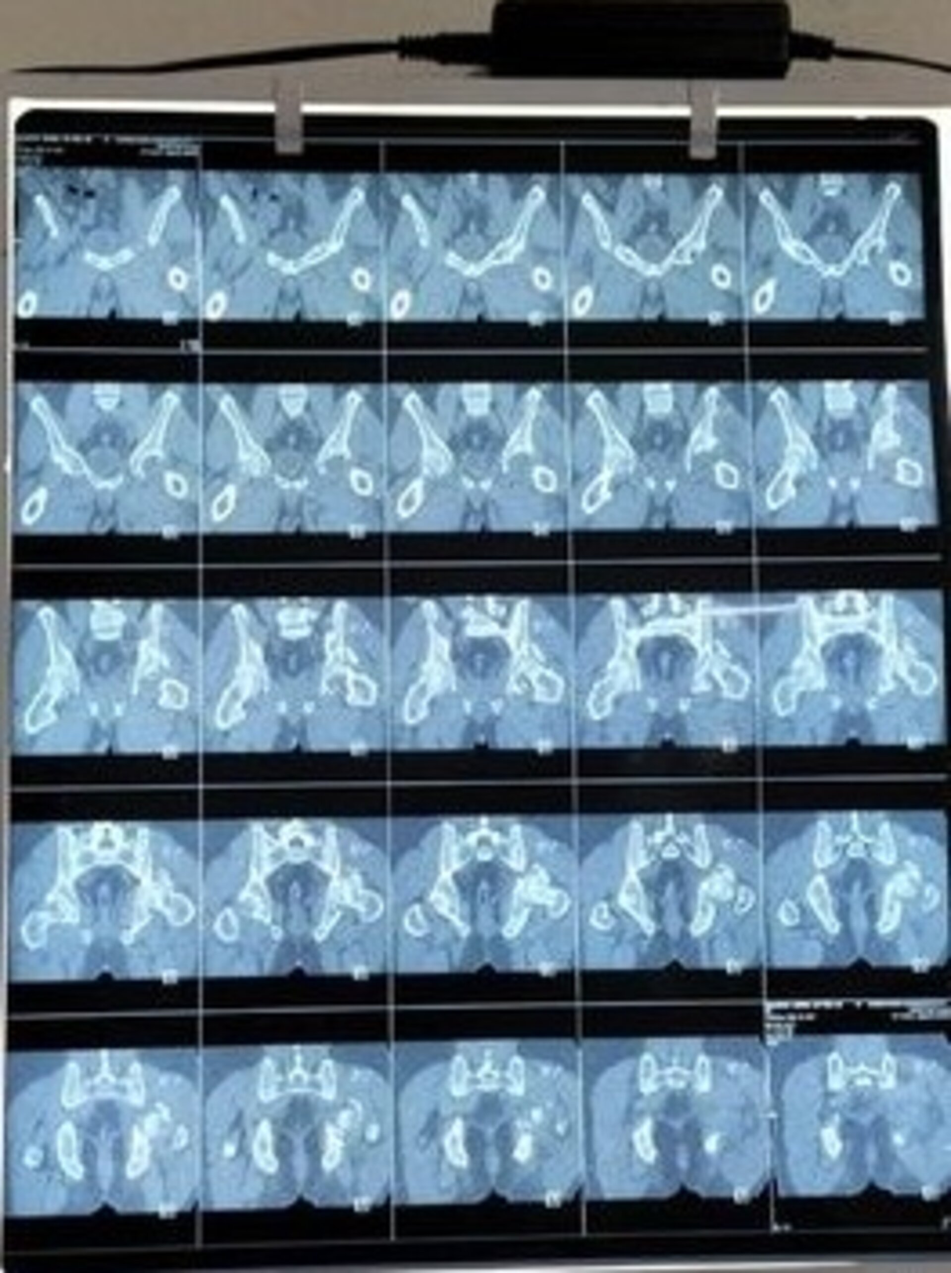 Comminuted acetabular fracture fixation | Dr. Jagdish Dhake