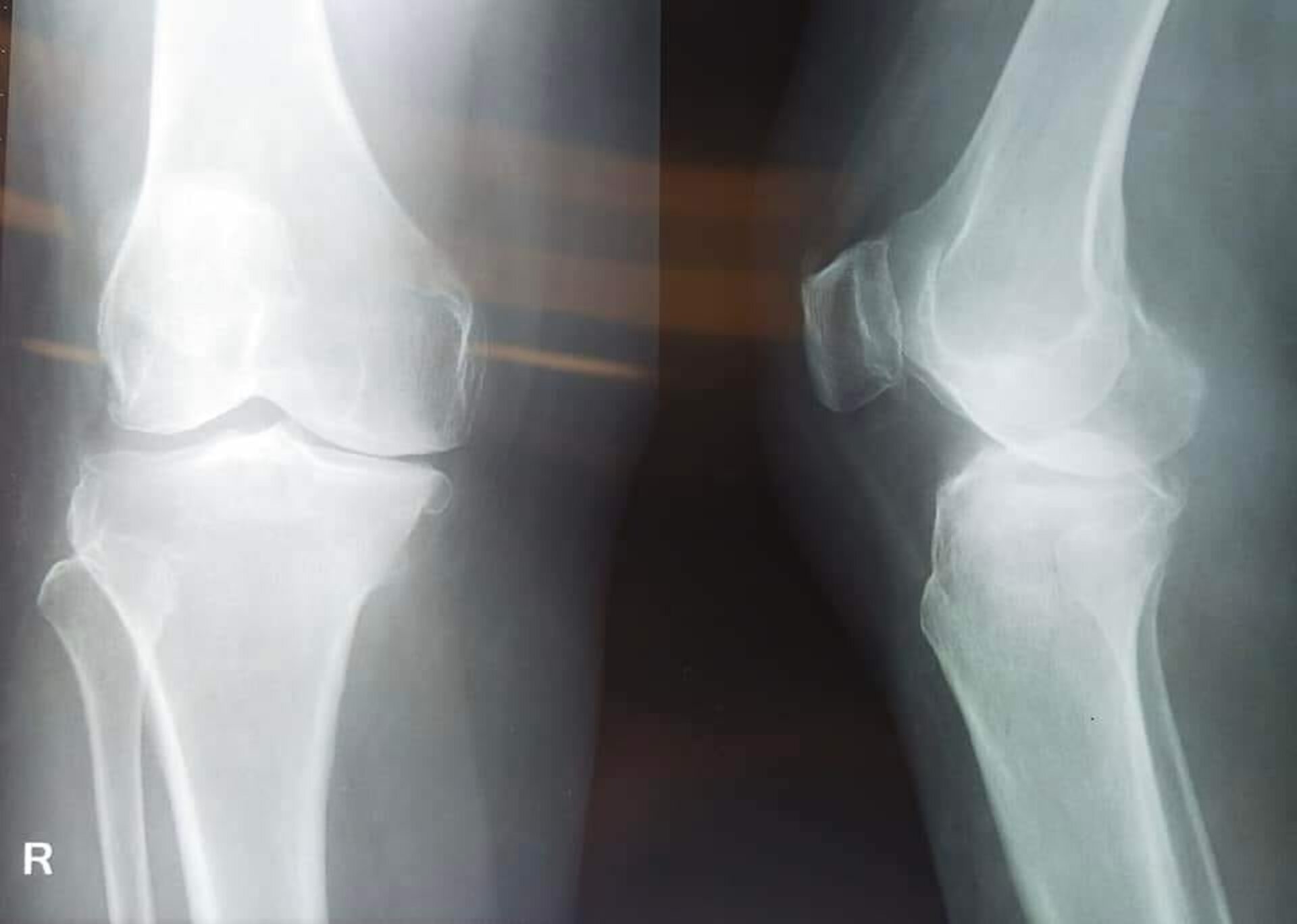 Treatment for Osteoarthritis by Dr. Jagdish Dhake | Knee replacement surgeon Pune