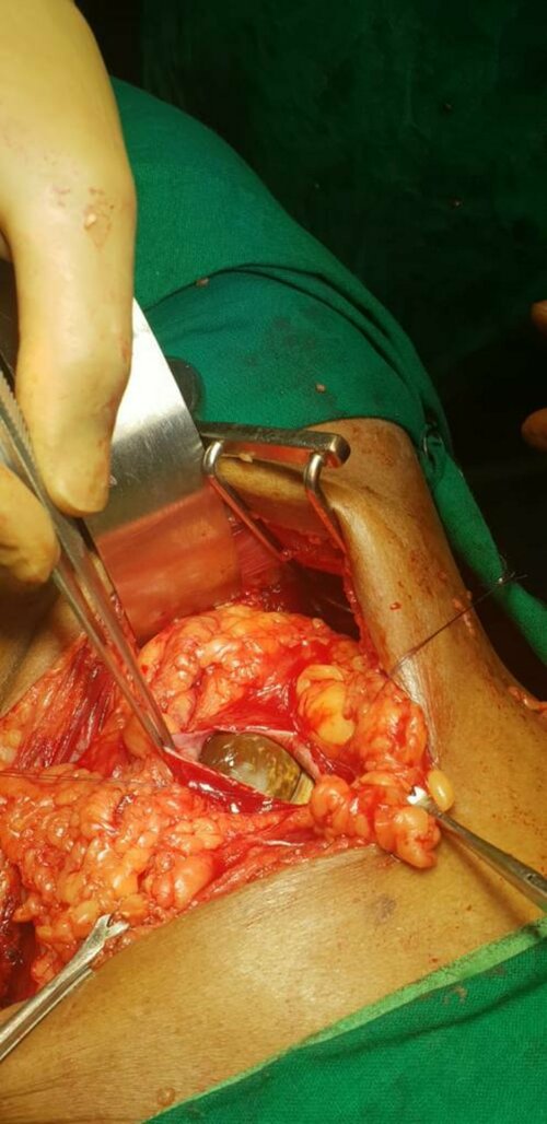 Large Kidney Stone Removed by Surgery in Pune | Dr. Bhoopat Bhati