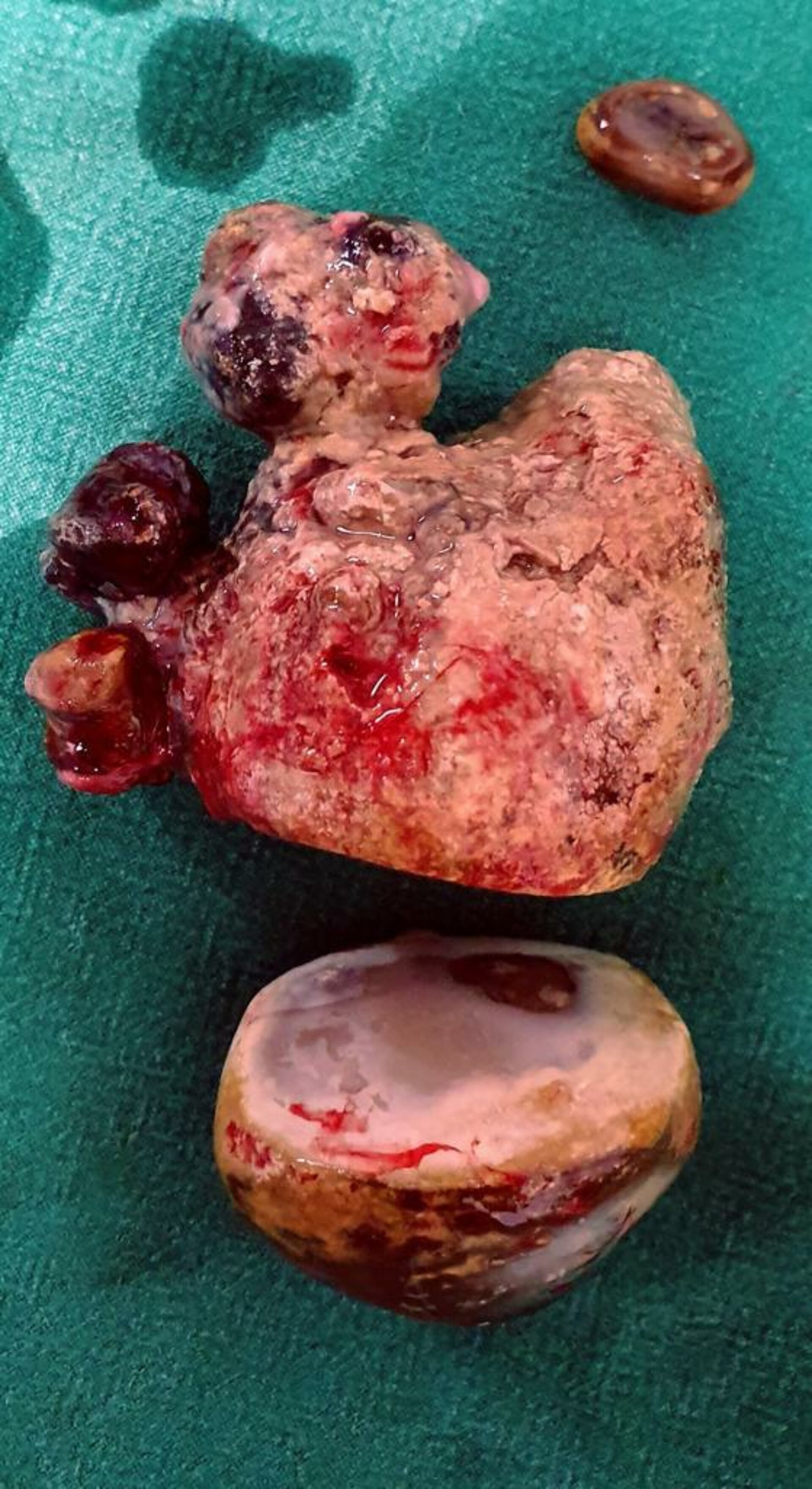 Large Kidney Stone Removed by Surgery in Pune | Dr. Bhoopat Bhati