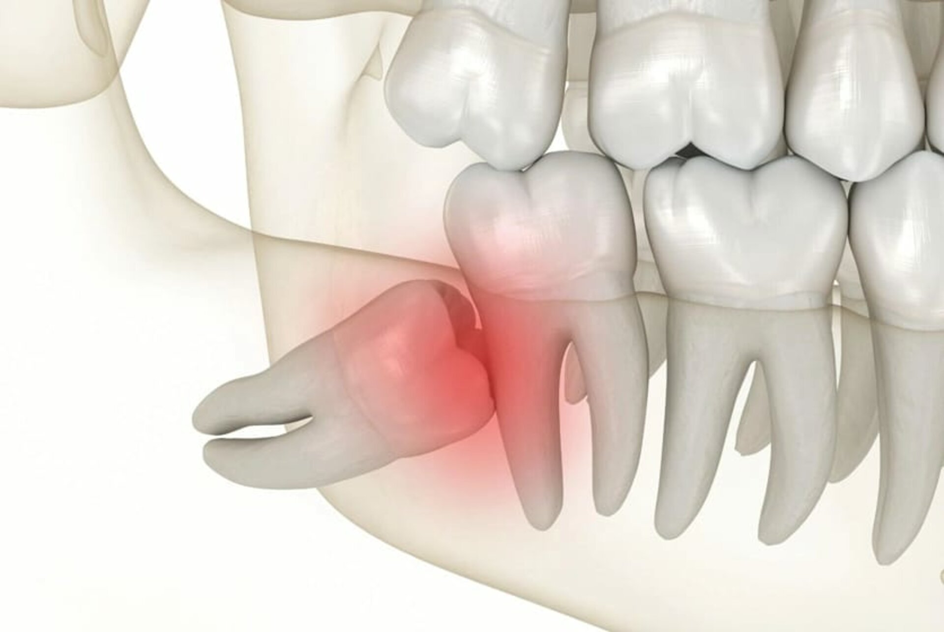 Is Wisdom Tooth Extraction Really Necessary? | Dr Prakash Patil