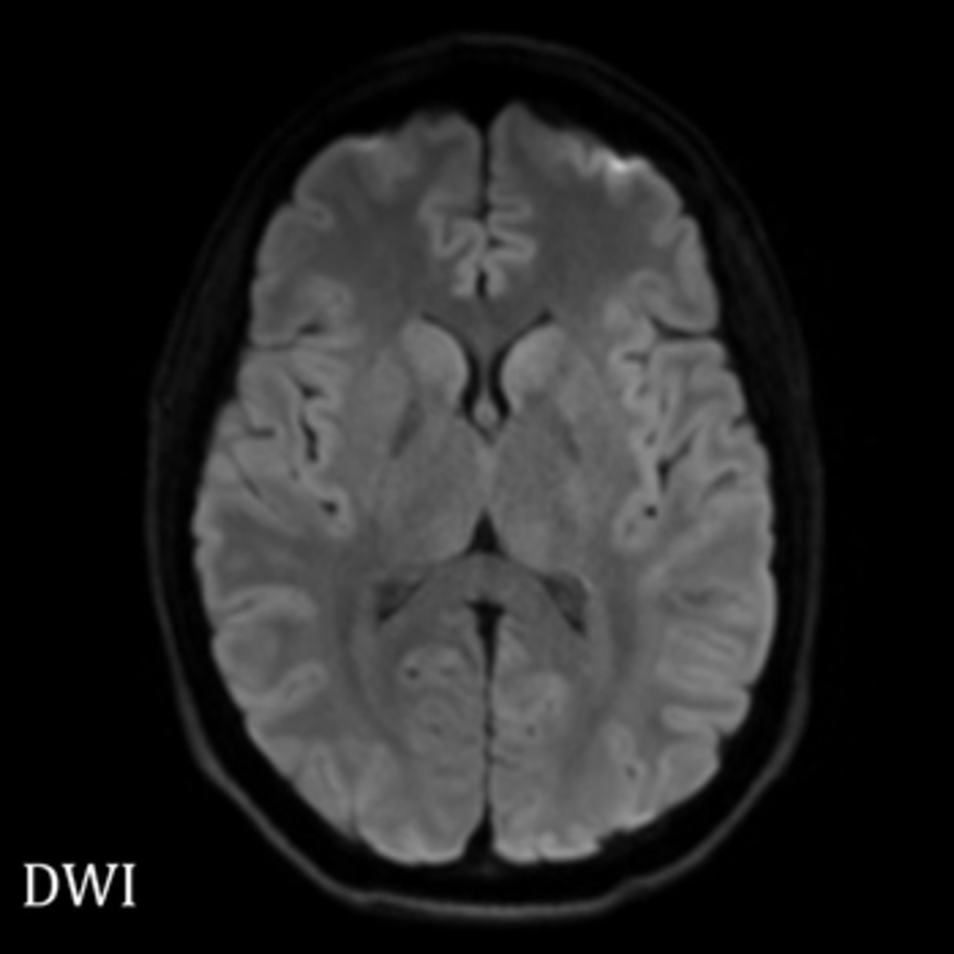 Interventional Neuro Radiology