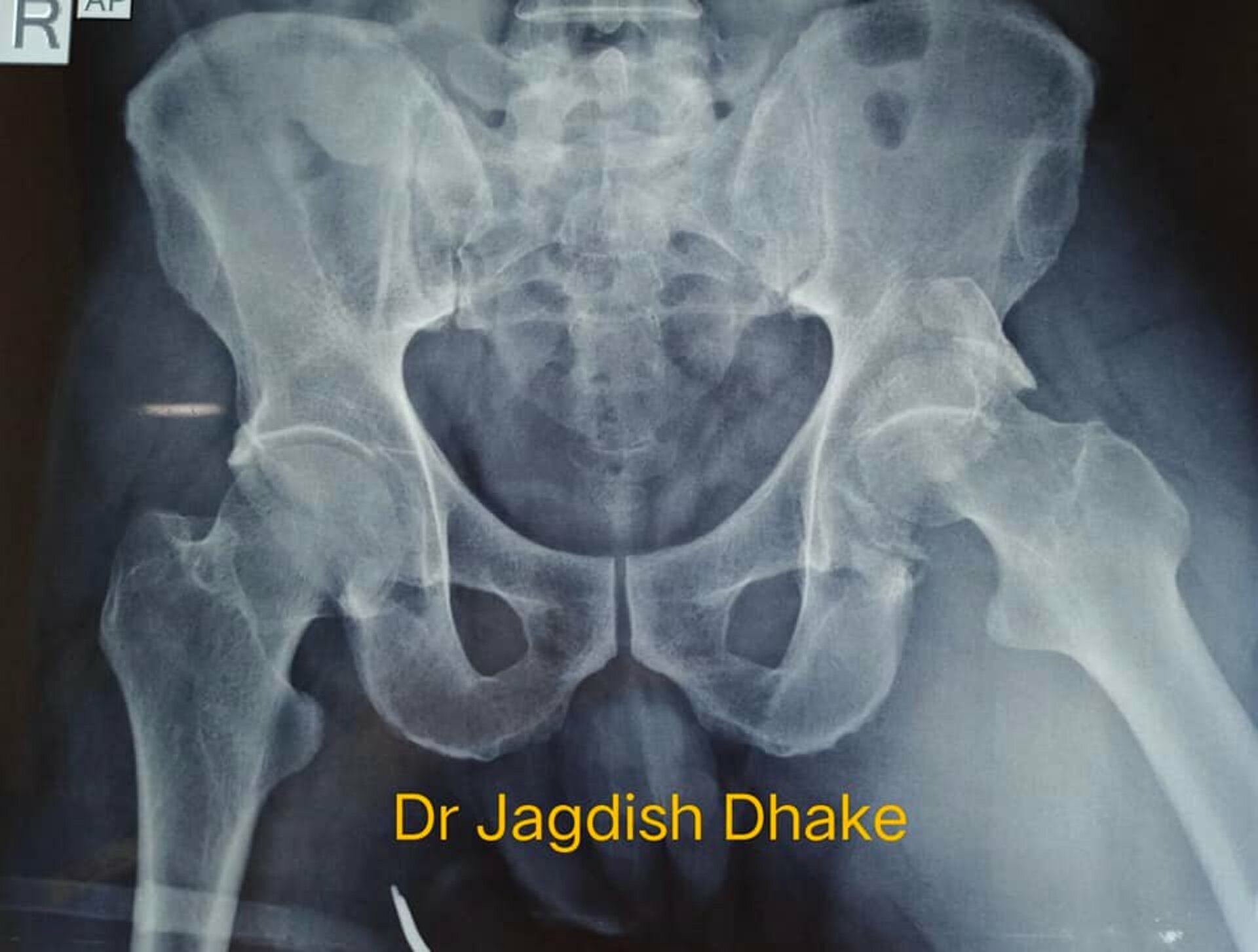 reconstruction of hip by Dr. Jagdish Dhake