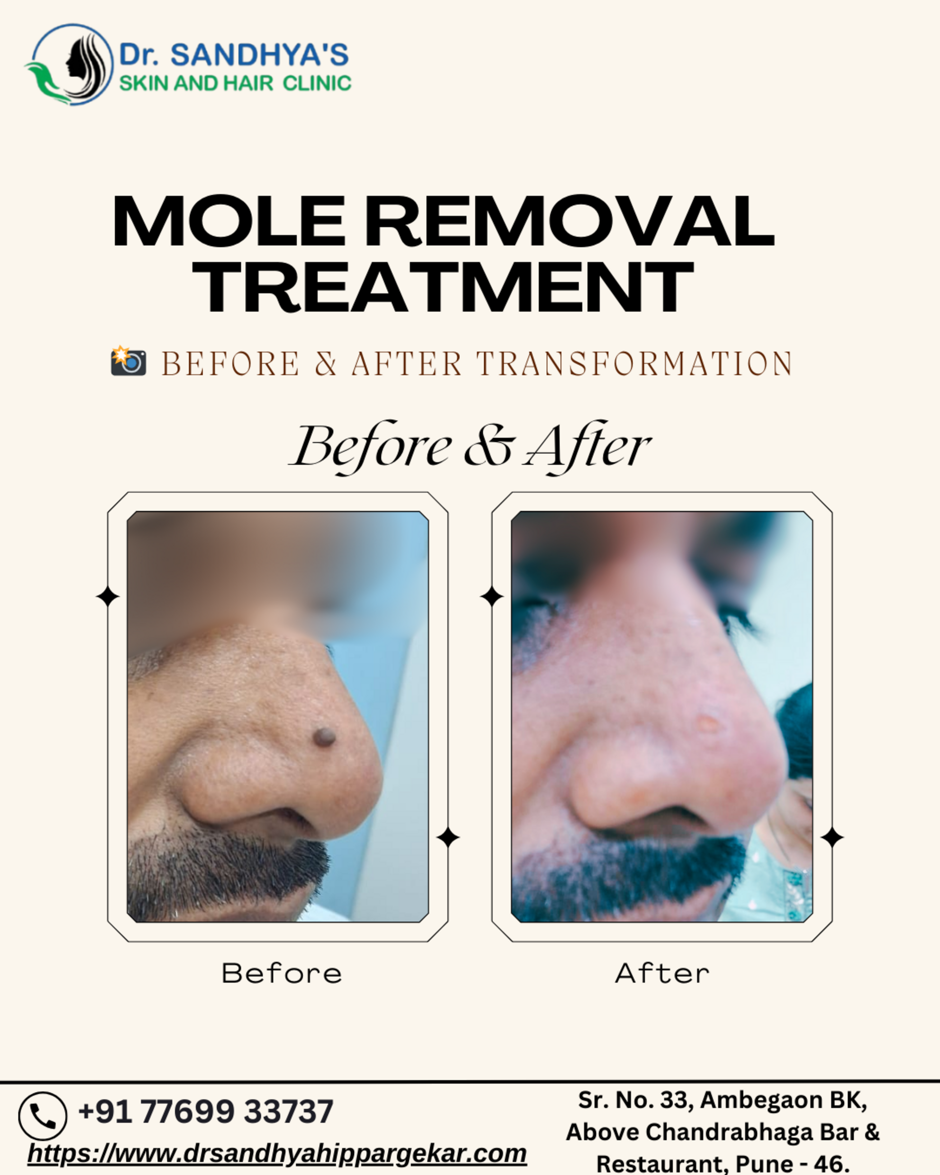mole treatment