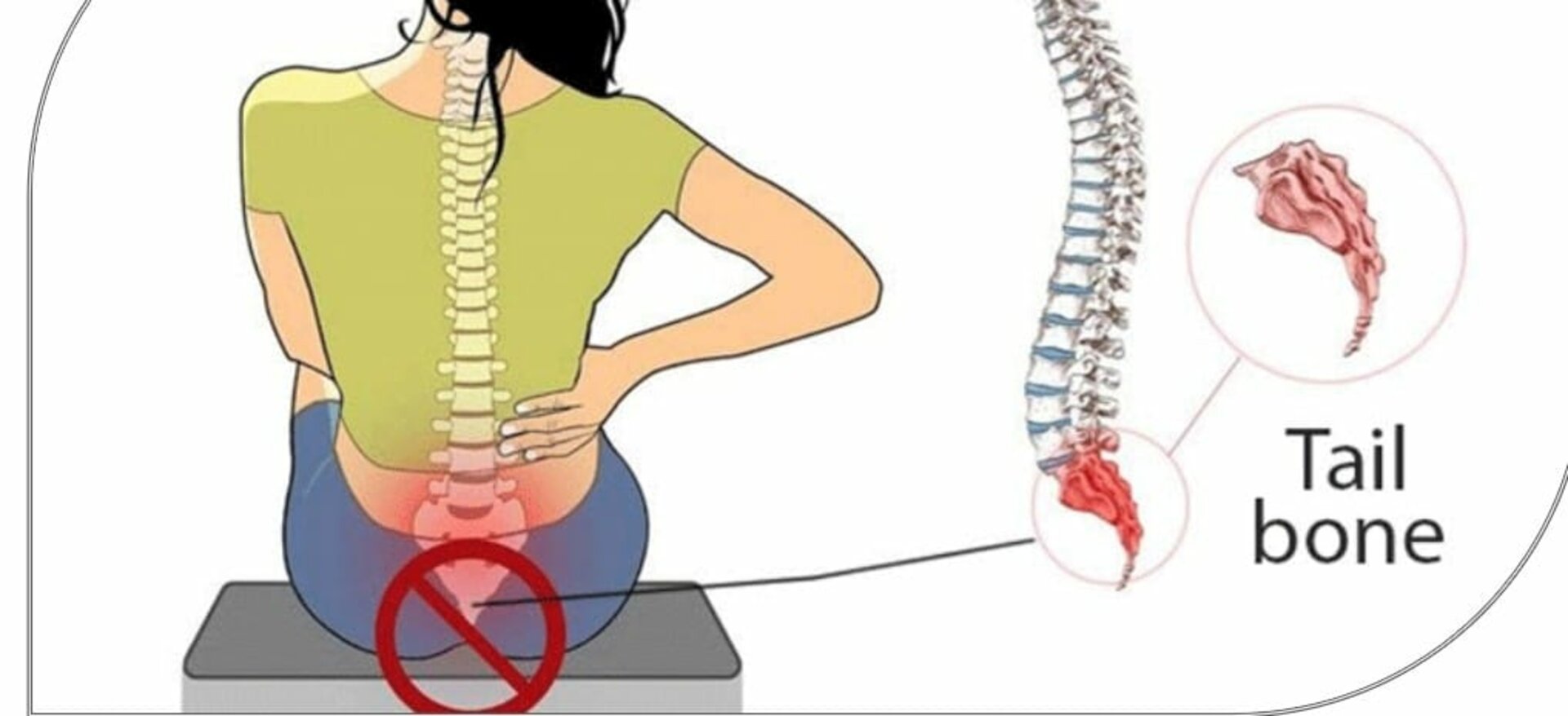 Do you feel pain in your tail bone area / middle of the hip ??? Understanding coccydynia??