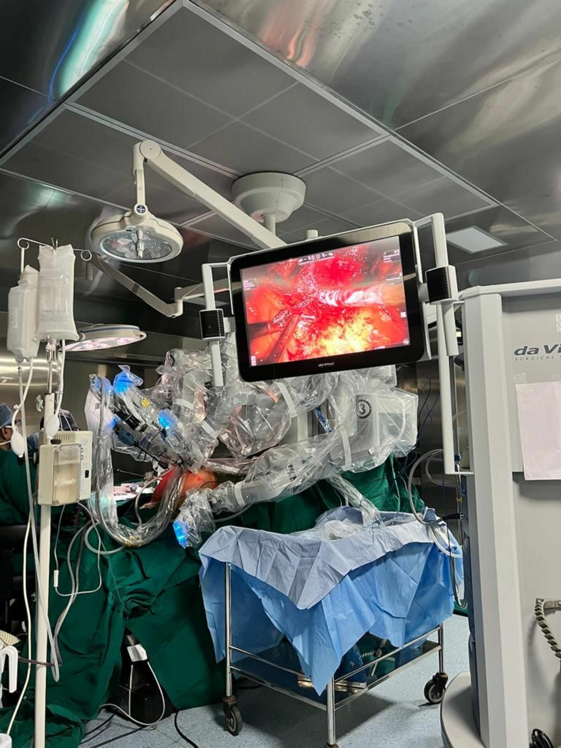 Robotic Radical Nephrectomy in Pune | Dr. Bhoopat Bhati | Urologist