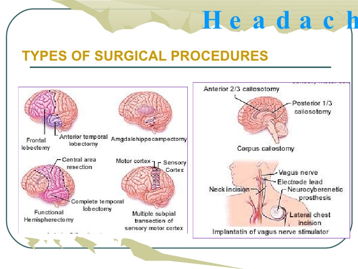 Epilepsy Surgery