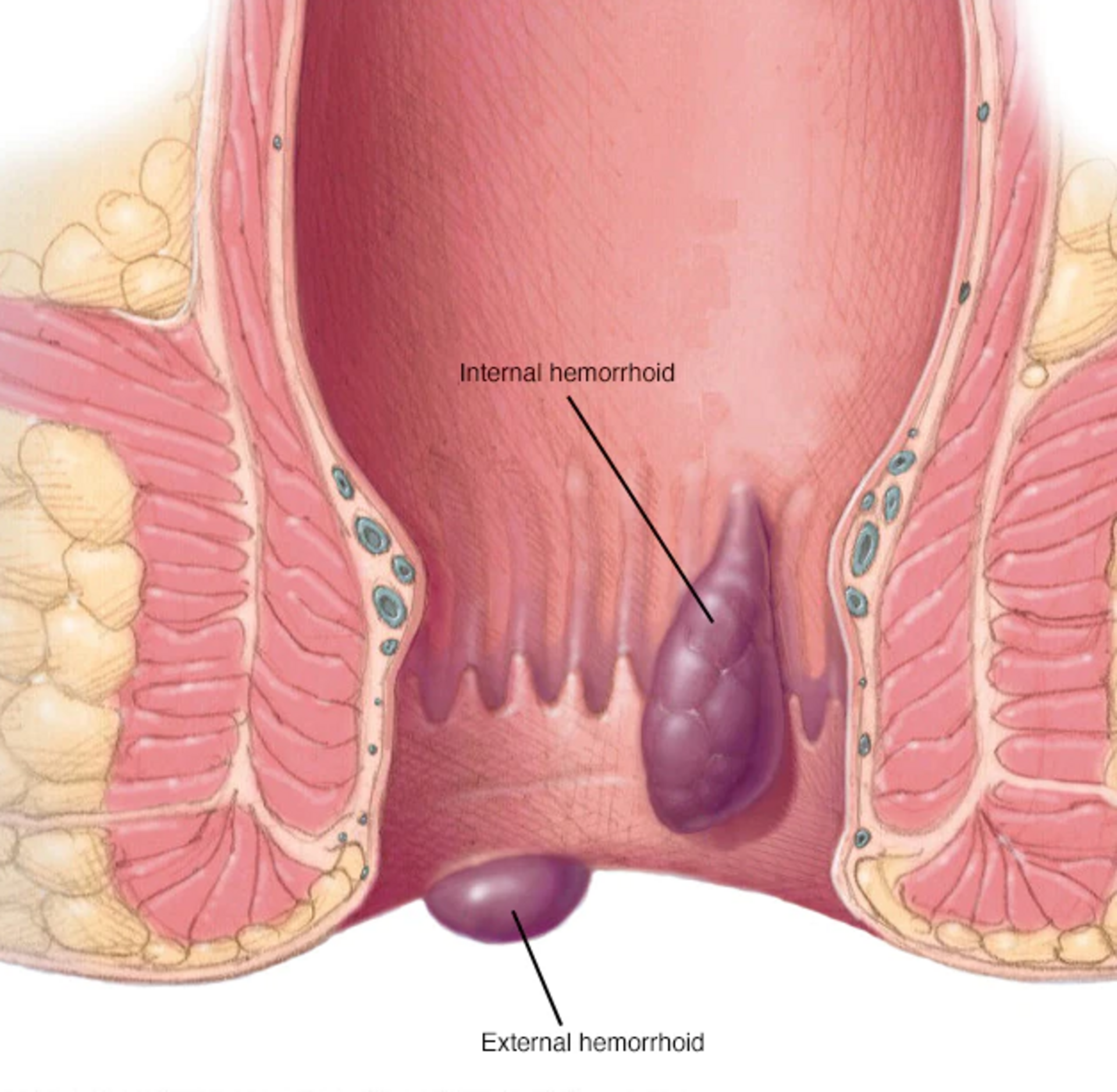 Piles/Hemorrhoids | Dr. Hina Khan