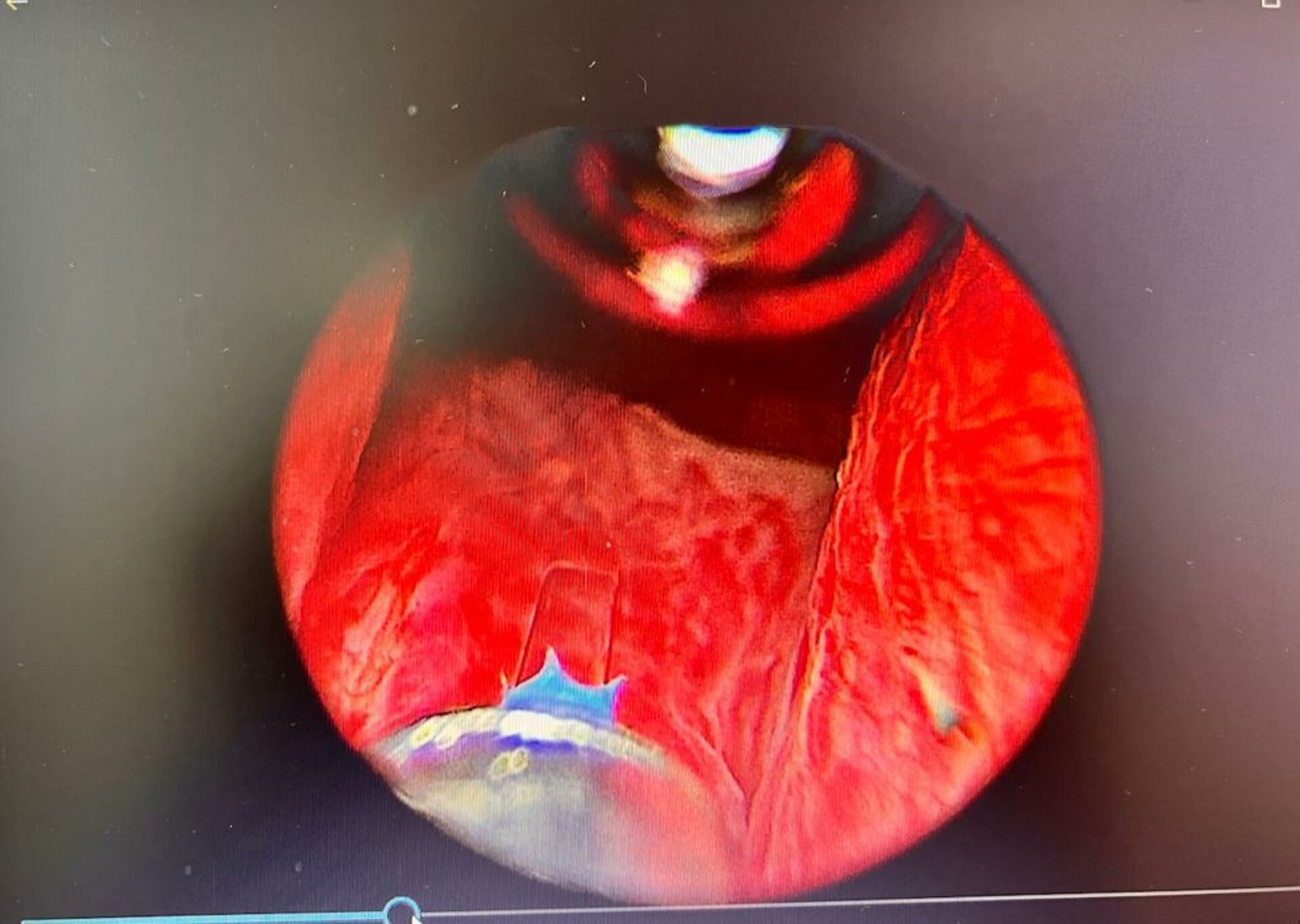 Urine Retention Post Angioplasty treated by Thulium laser Enucleation of Prostate | Dr. Bhoopat Bhati