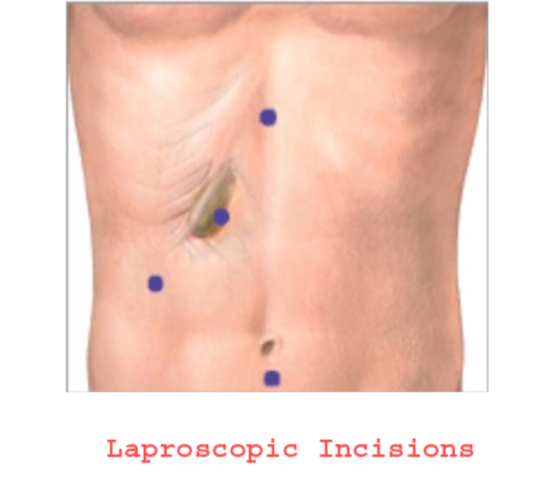 Laparoscopic Cholecystectomy | Dr. Sameer Badami