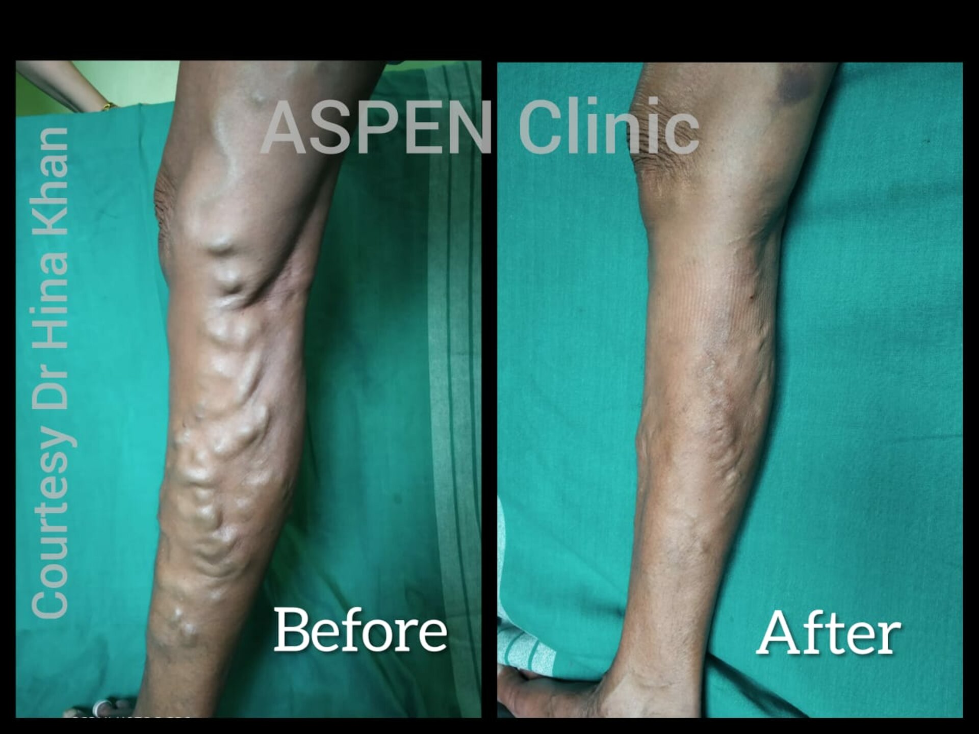 Laser Treatment of Varicose Veins | Dr. Hina Khan