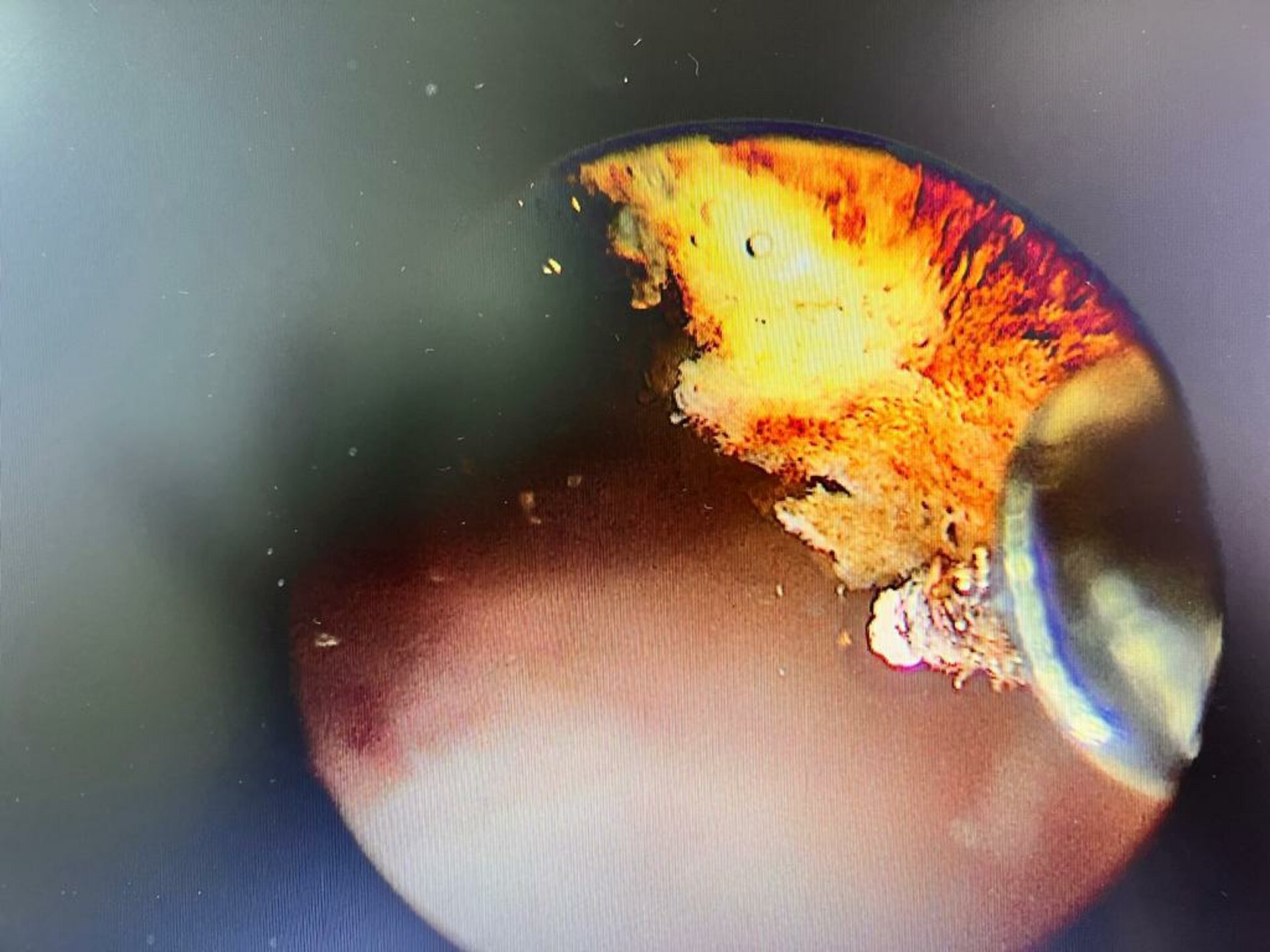 Urine Retention Post Angioplasty treated by Thulium laser Enucleation of Prostate | Dr. Bhoopat Bhati
