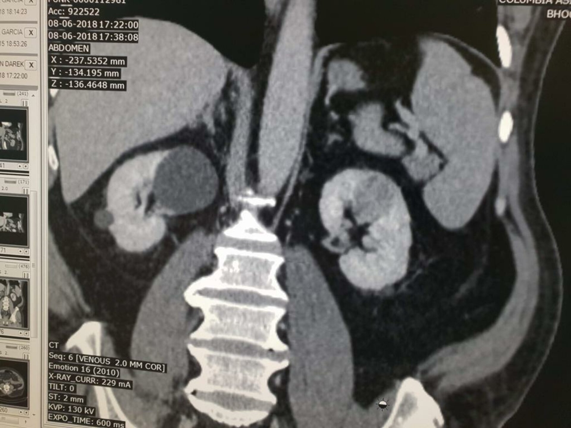 Abdomen Pain Caused by Left Renal mass Treated with Open Partial Nephron Sparing | Dr. Bhoopat Bhati