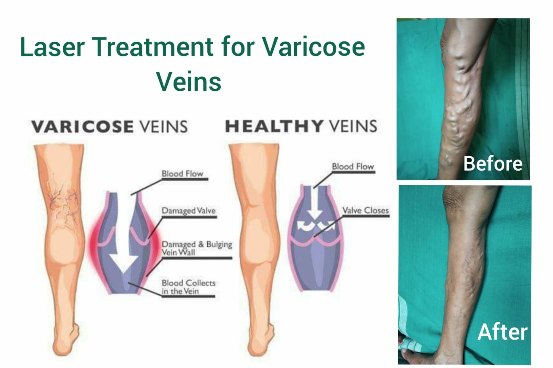 Laser Treatment of Varicose Veins | Dr. Hina Khan