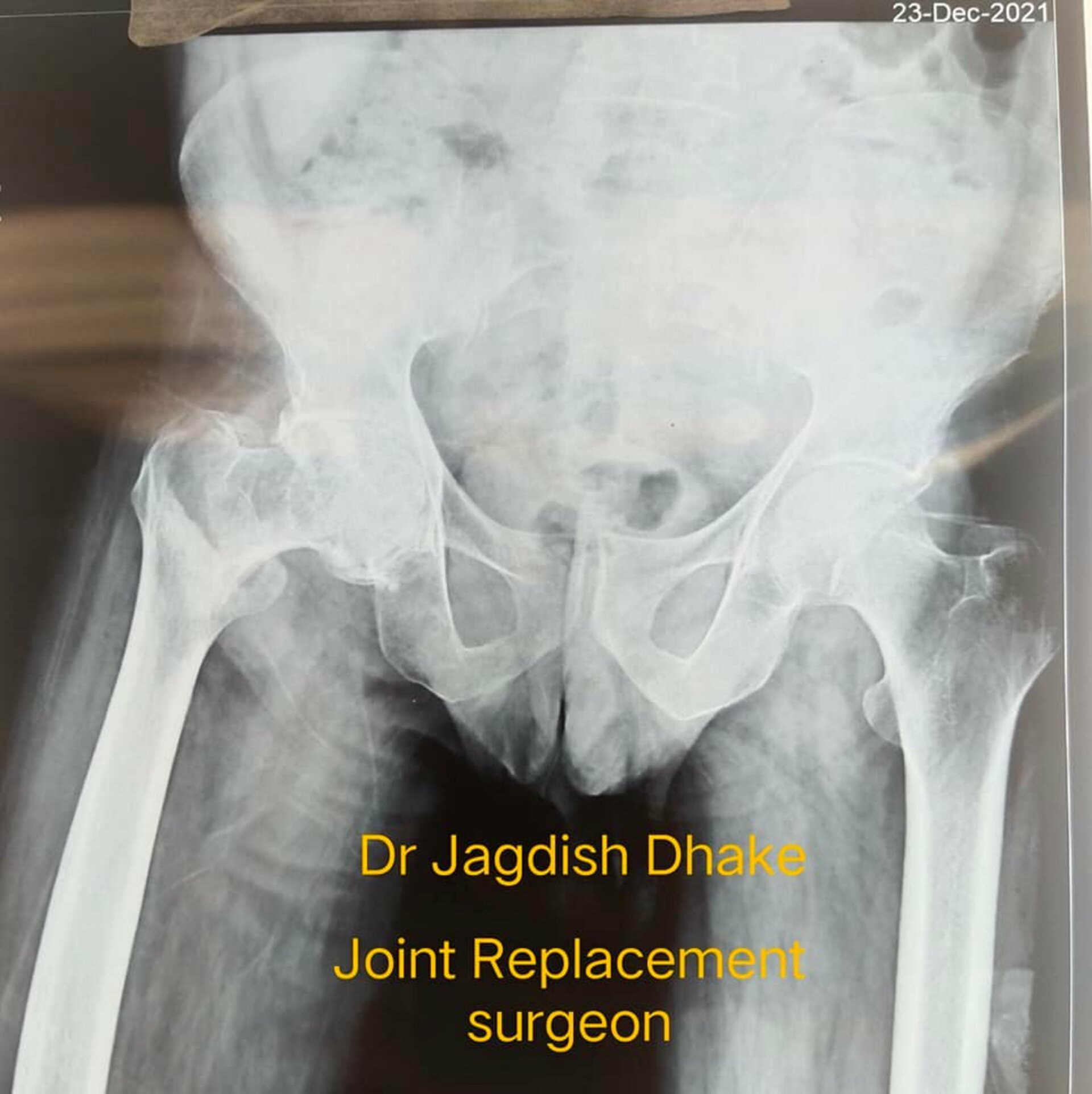 Hybrid total hip replacement | Dr. Jagdish Dhake