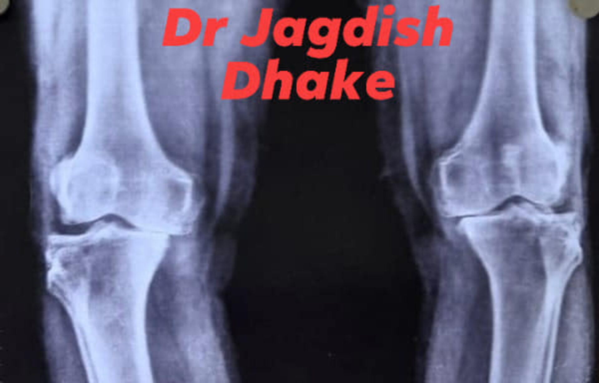 Total Knee Replacement - Dr. Jadish Dhake