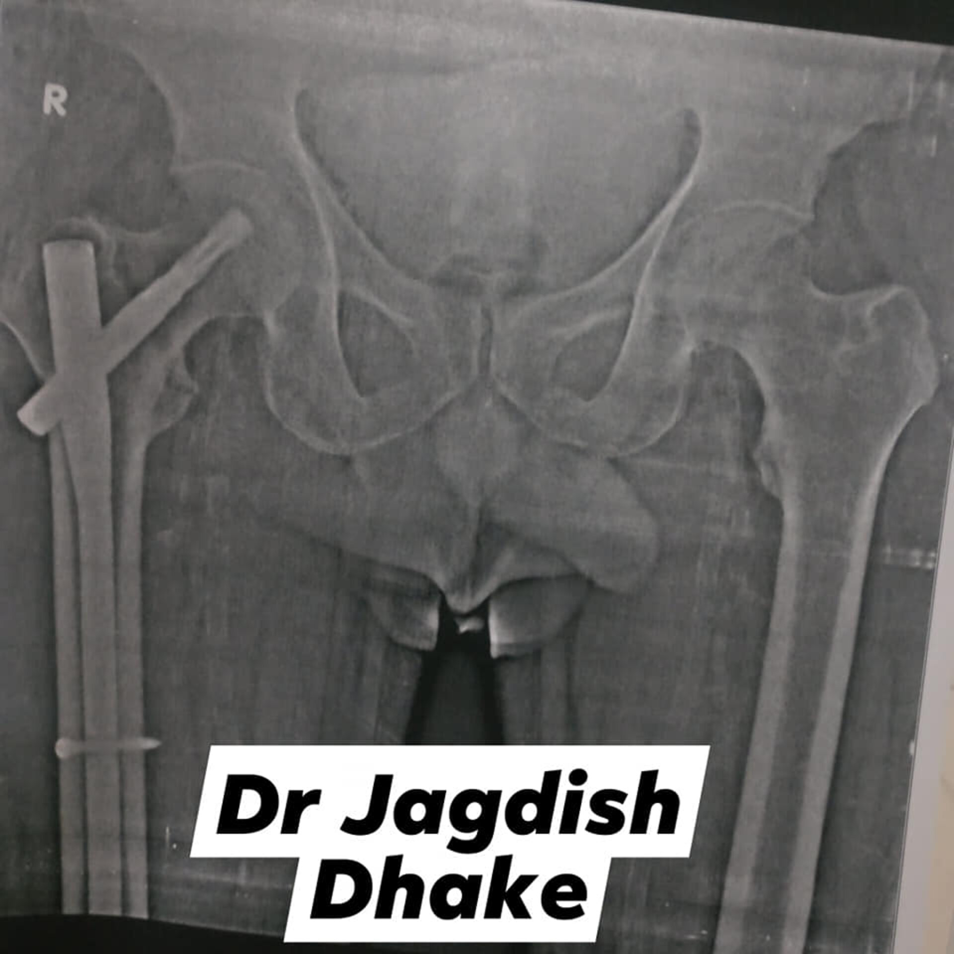 Happy patient cases | Dr. Jagdish Dhake - Orthopedic in Bibvewadi