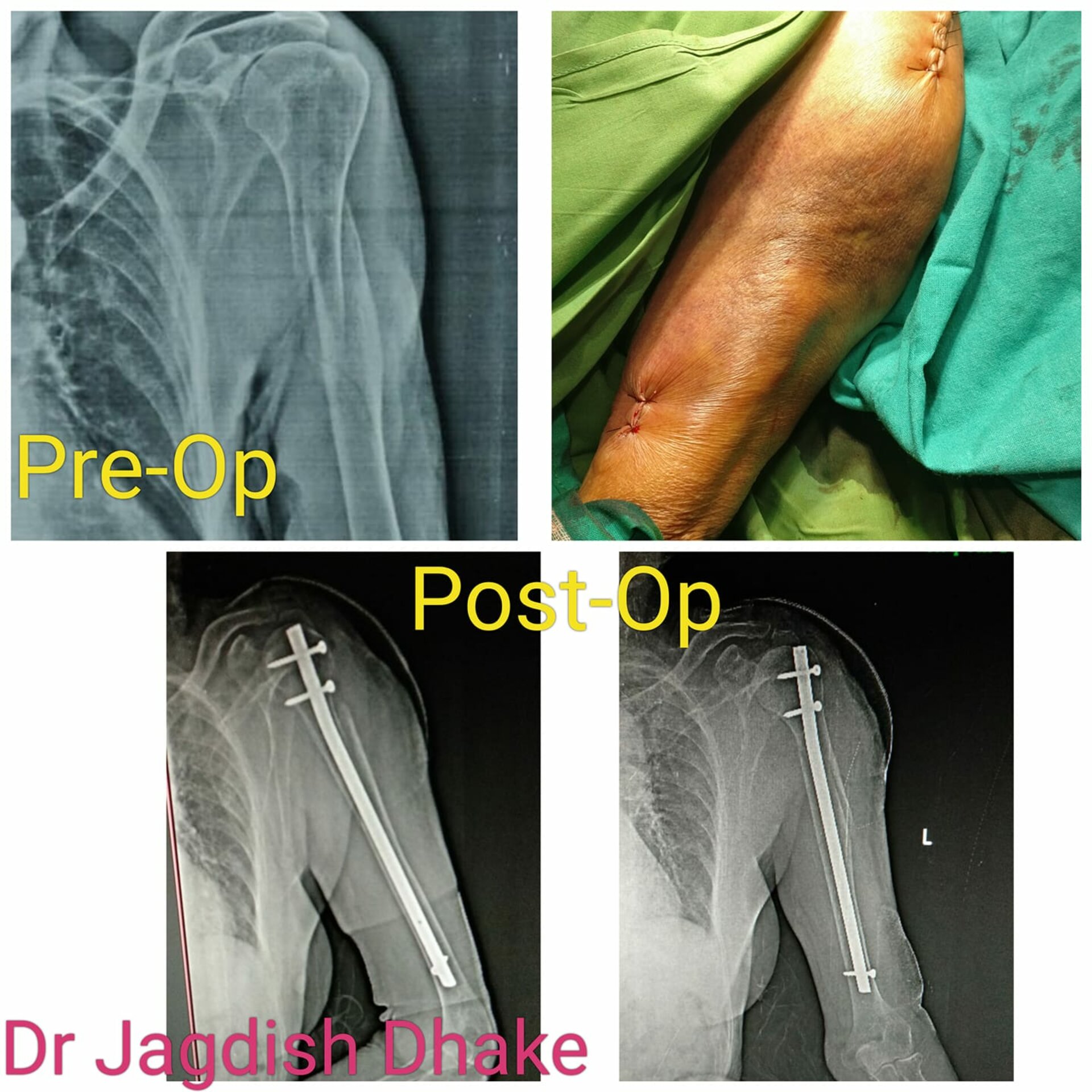 Patient undergoes CRIF | Dr. Jagdish Dhake - Orthopedic Surgeon