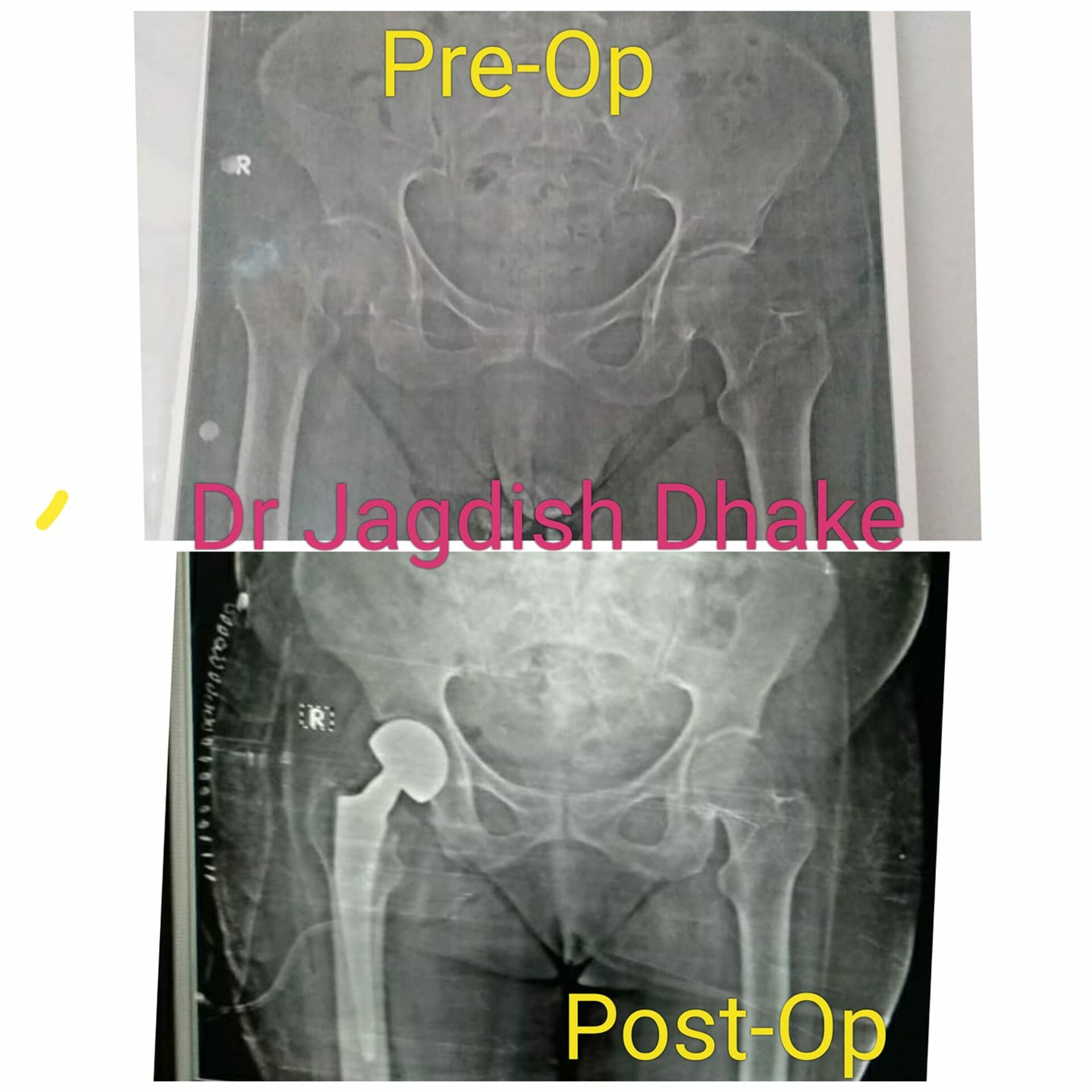 Patient undergoes Cemented Bipolar hemi-replacement | Dr. Jagdish Dhake