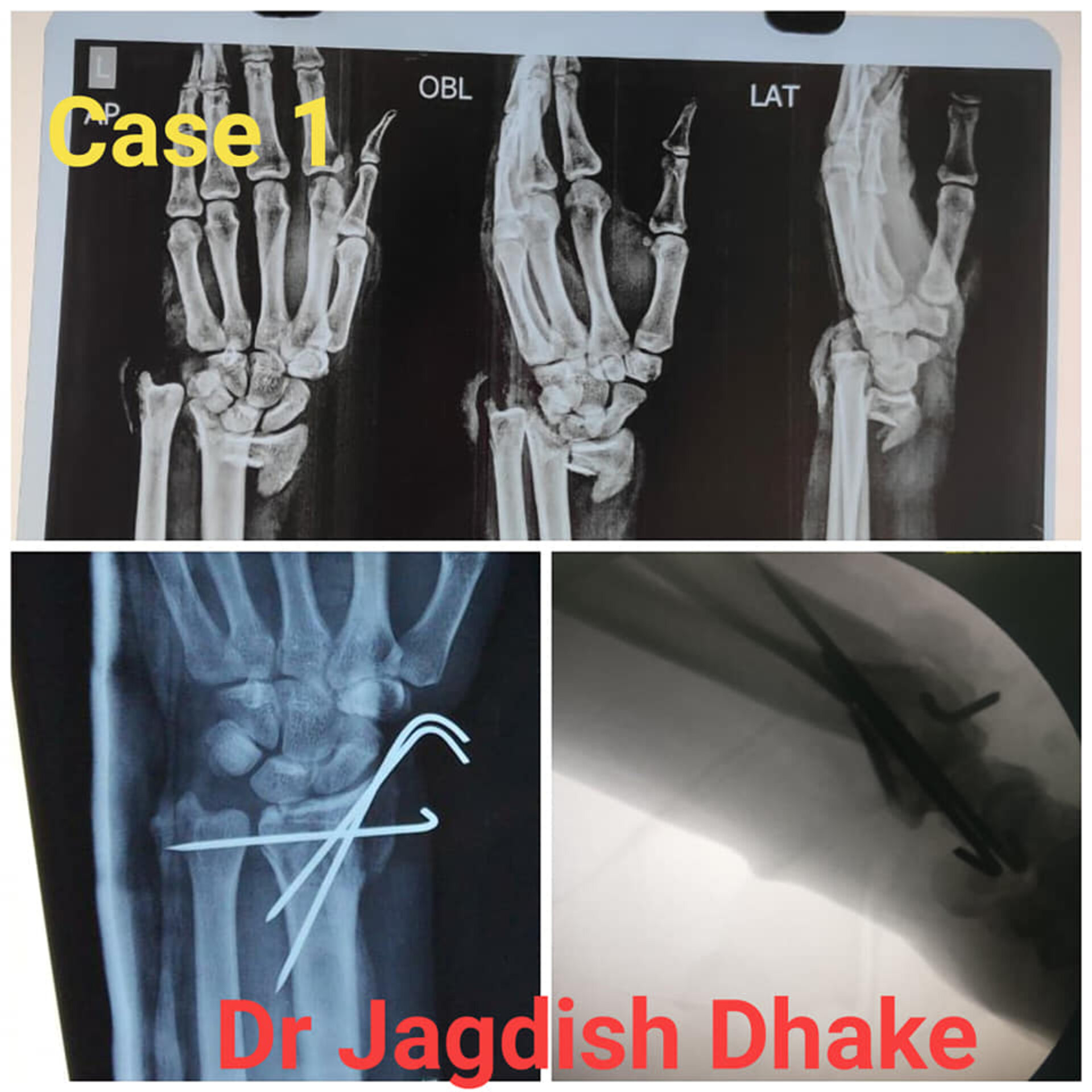 Cases handled by Dr. Jagdish Dhake - Orthopedic Surgeon