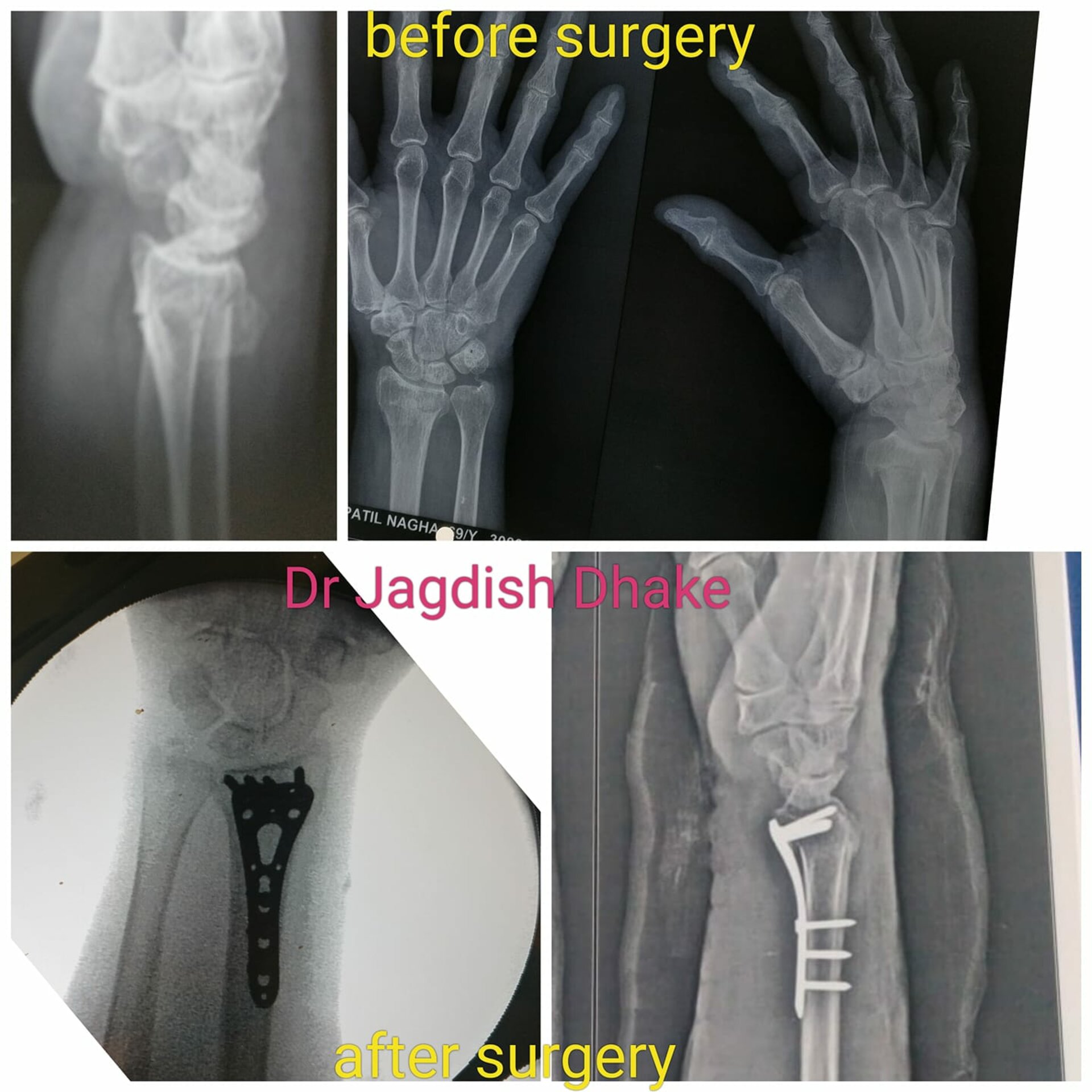 Fracture Distal Radius | Dr. Jagdish Dhake - Orthopedic Surgeon