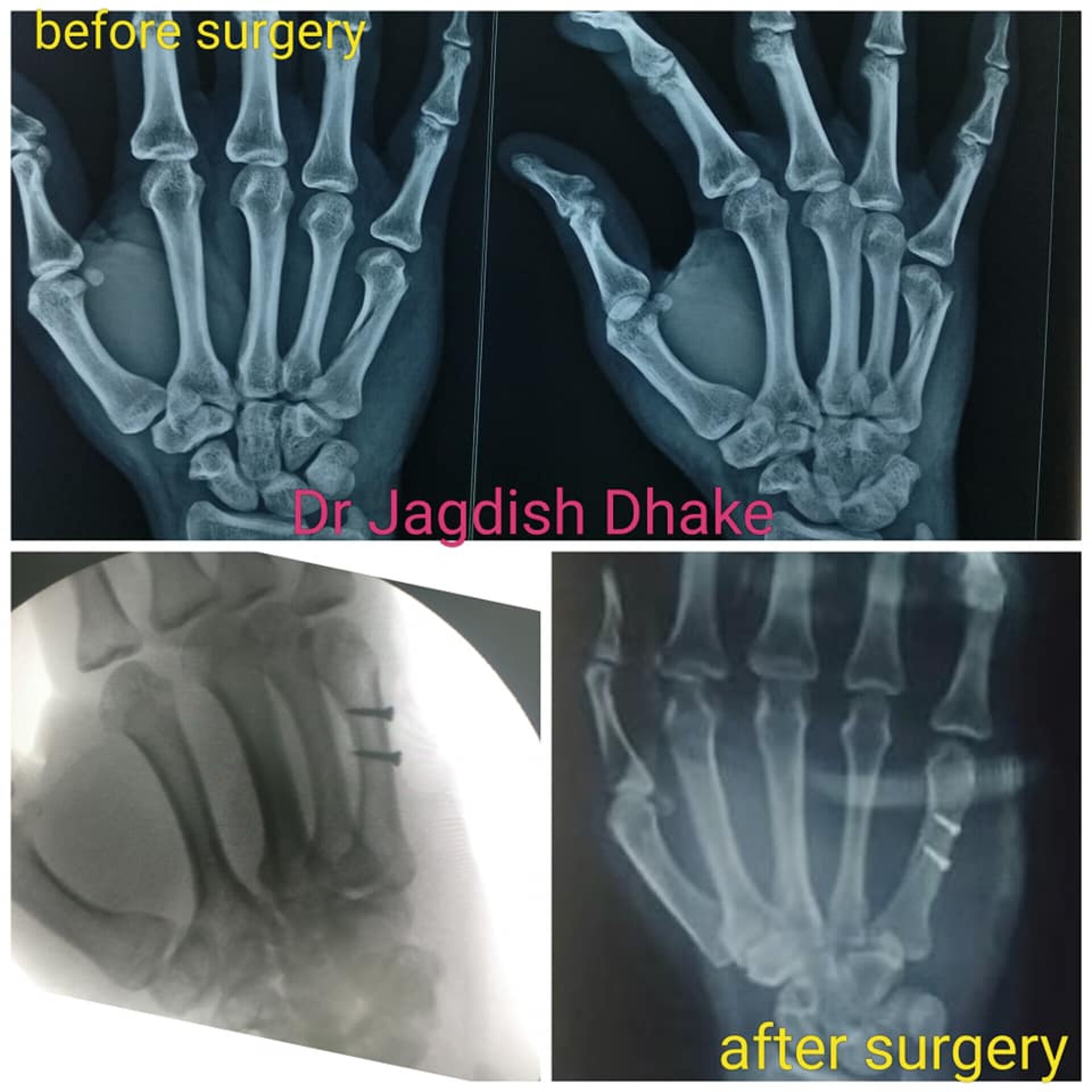 Hand Injury Case | Dr. Jagdish Dhake | Orthopedic Surgeon in Bibvewadi