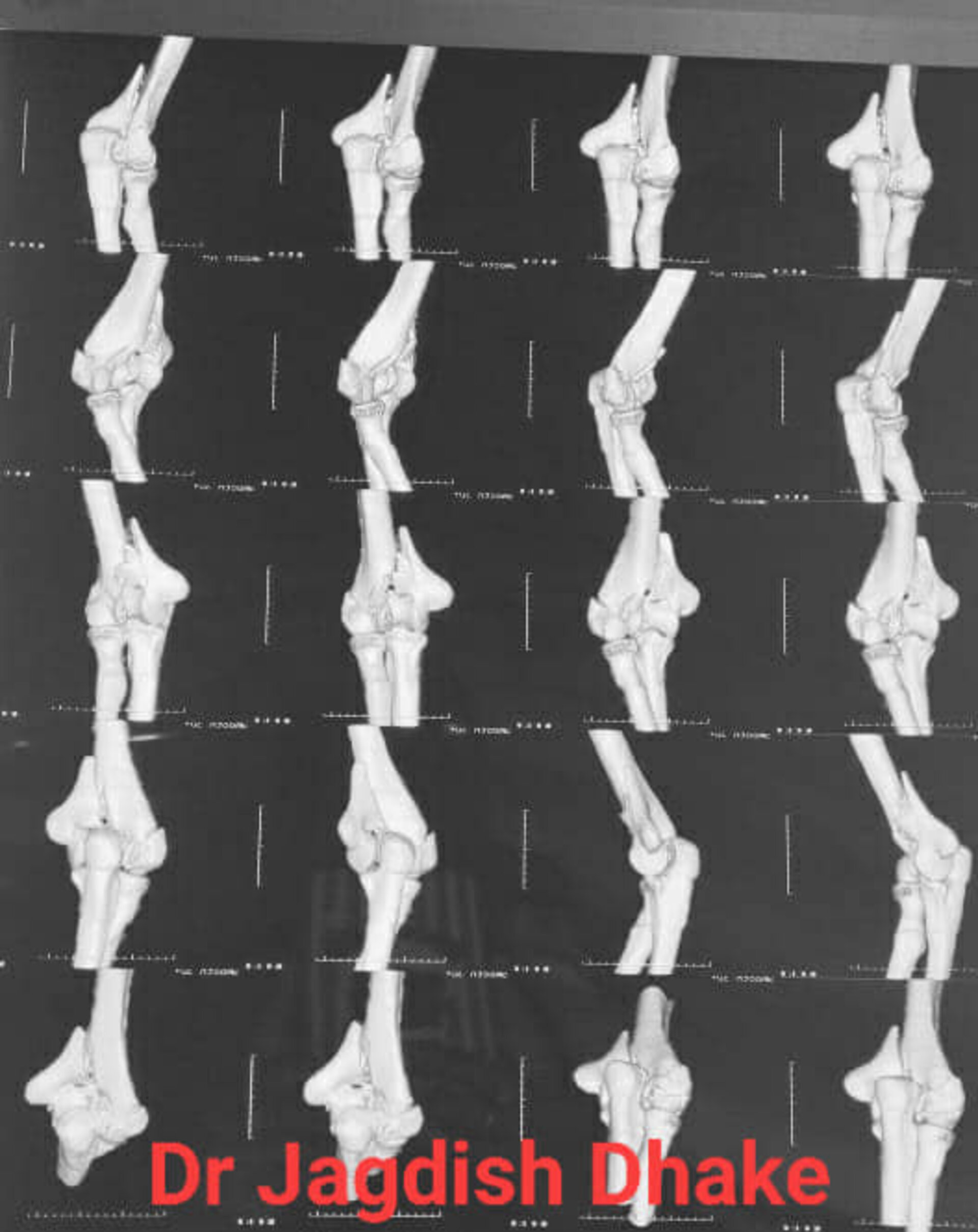 Distal Humerus Comminuted Fracture | Dr. Jagdish Dhake