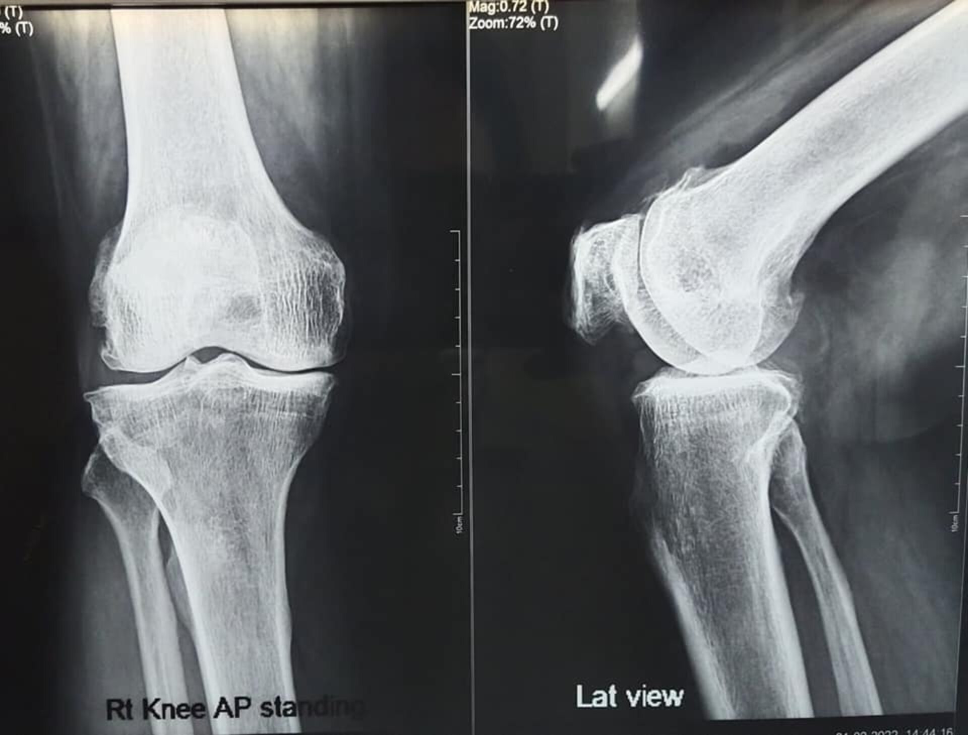 60-year male undergoes Bilateral Total Knee Replacement | Dr. Jagdish Dhake