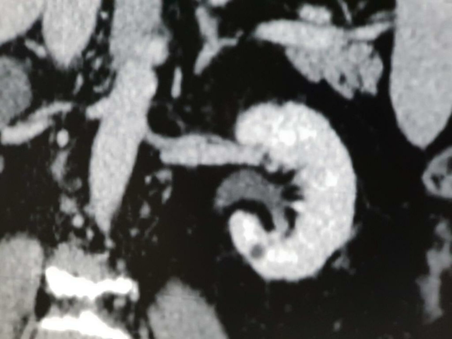Abdomen Pain Caused by Left Renal mass Treated with Open Partial Nephron Sparing | Dr. Bhoopat Bhati
