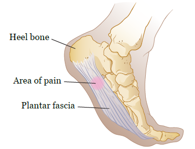 Plantar Fasciitis