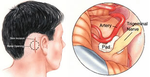 Microvascular Decompression Surgeries