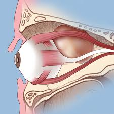 Orbital Surgery - Dr Prashant Khandelwal