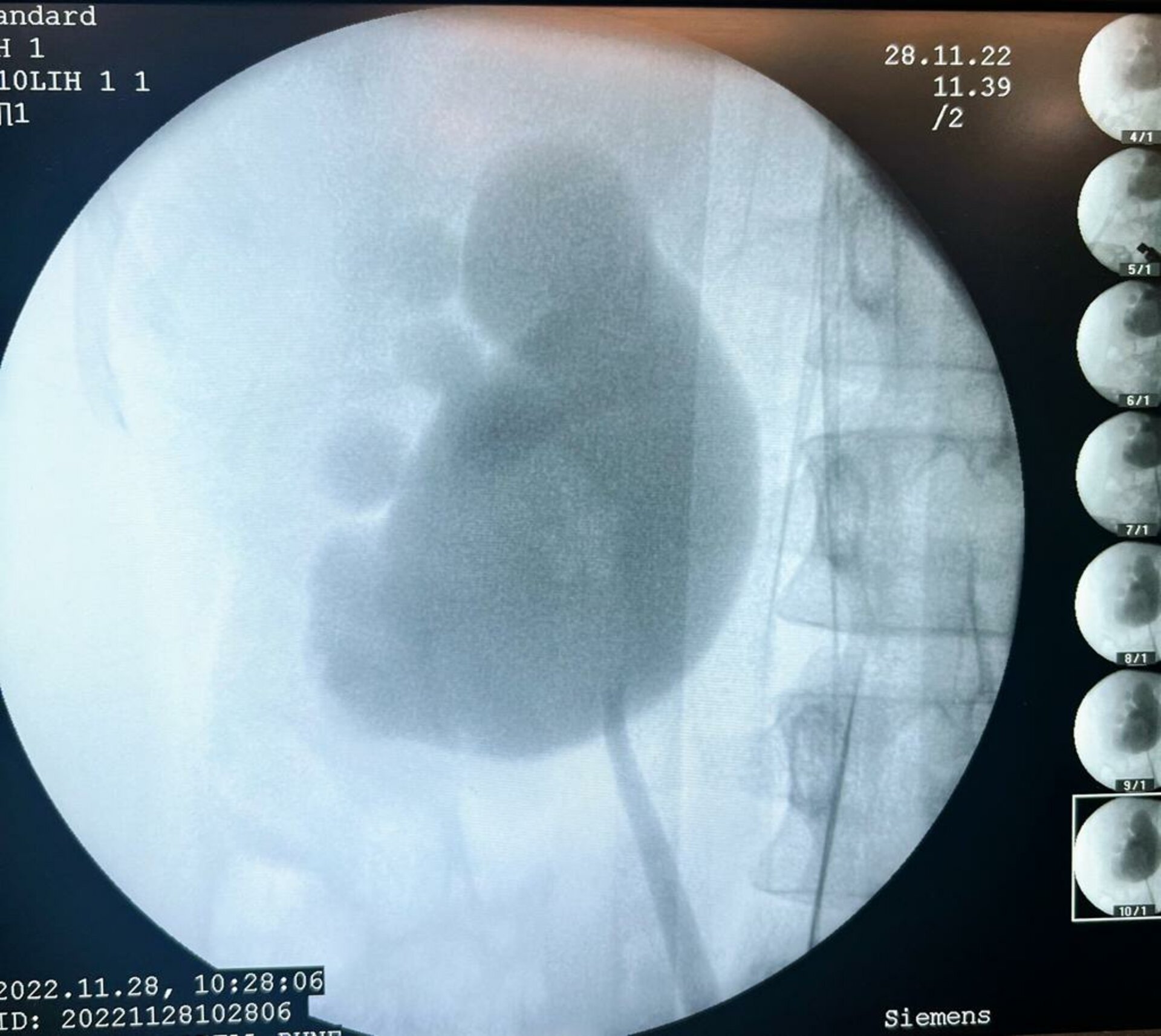 Abdomen Pain caused by PUJ Obstruction by Laparoscopic Pyeloplasty | Dr. Bhoopat Bhati