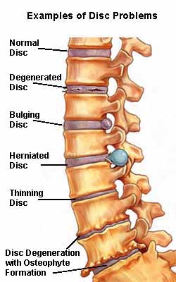 Spine Surgery - Dr Prashant Khandelwal