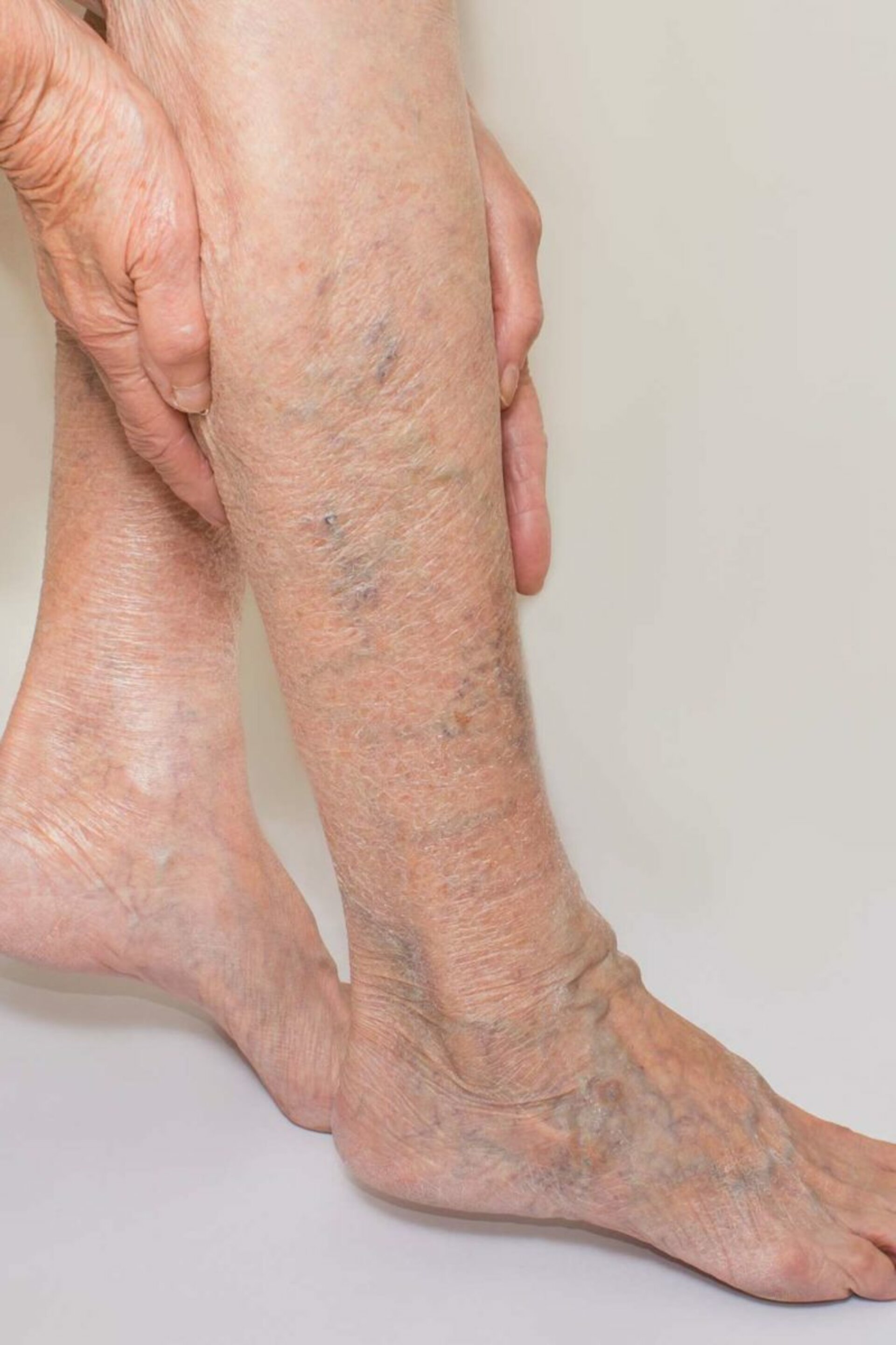 Varicose Veins Treatment| Dr. Advait Kothurkar