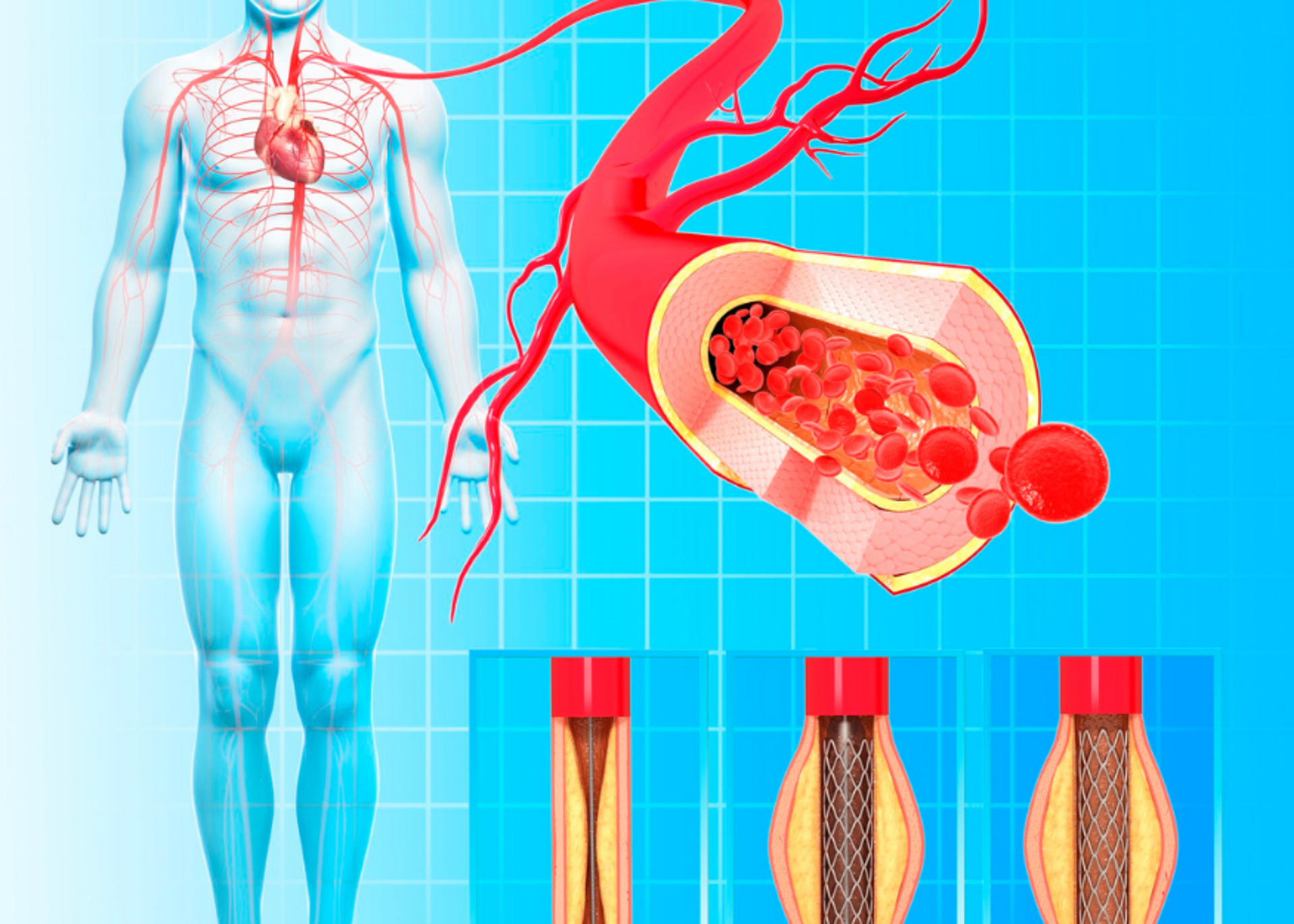 When Do You Need a Coronary Stent? | Dr. Mehul Rathod
