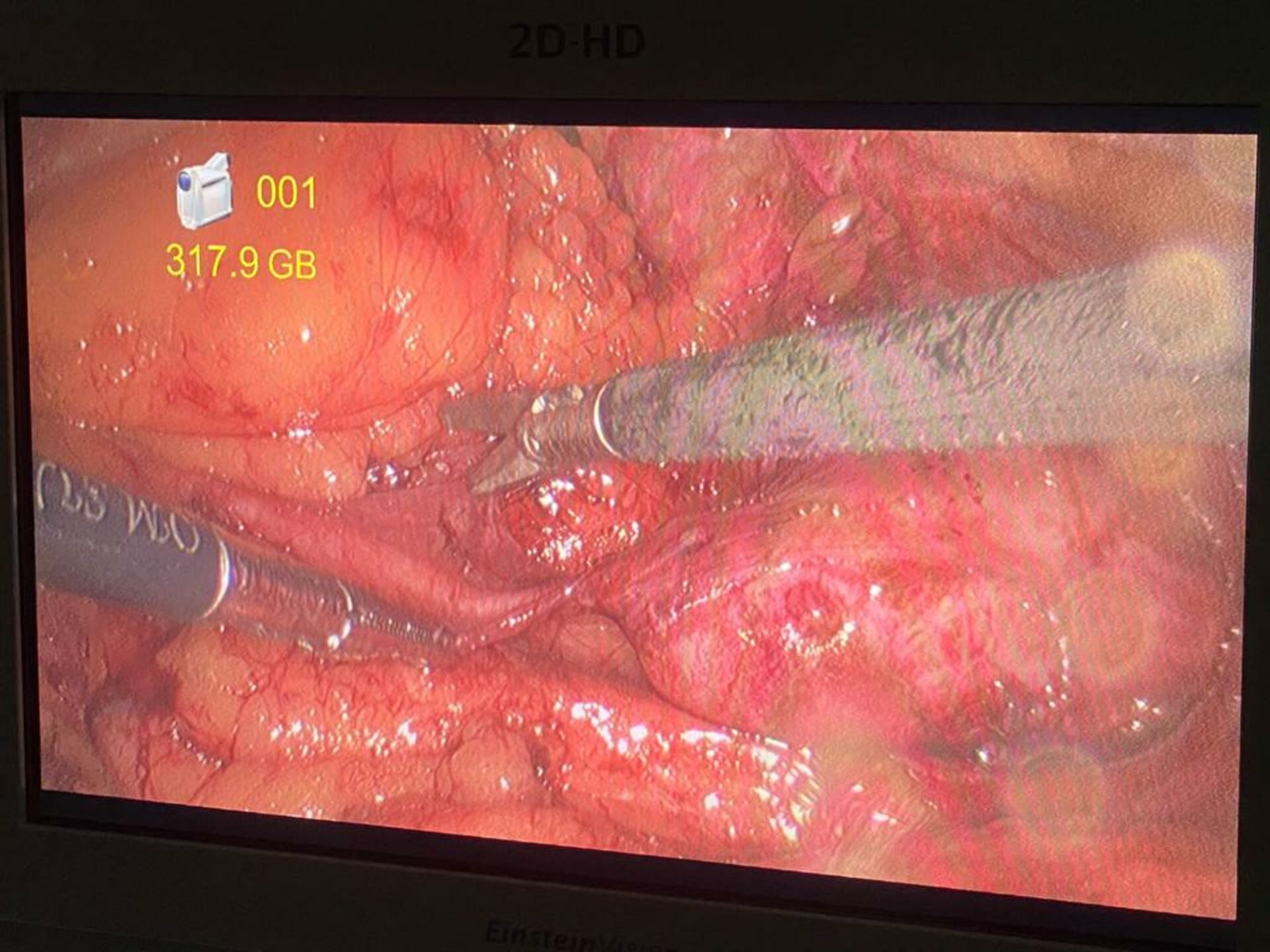 Abdomen Pain Caused by PUJ Obstruction Treated by 3D Laproscopic Pyeloplasty | Dr. Boopat Bhati