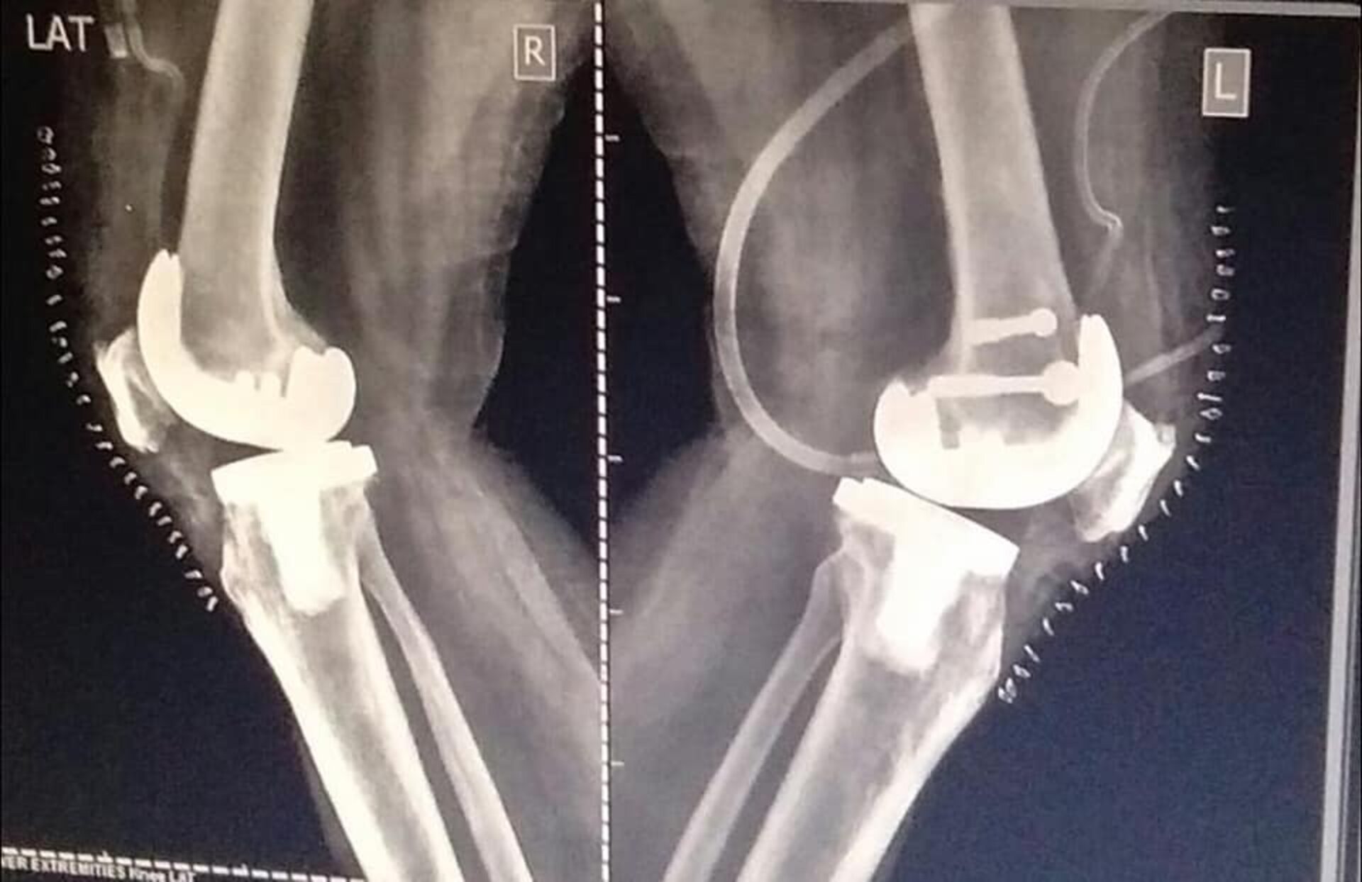 60-year male undergoes Bilateral Total Knee Replacement | Dr. Jagdish Dhake