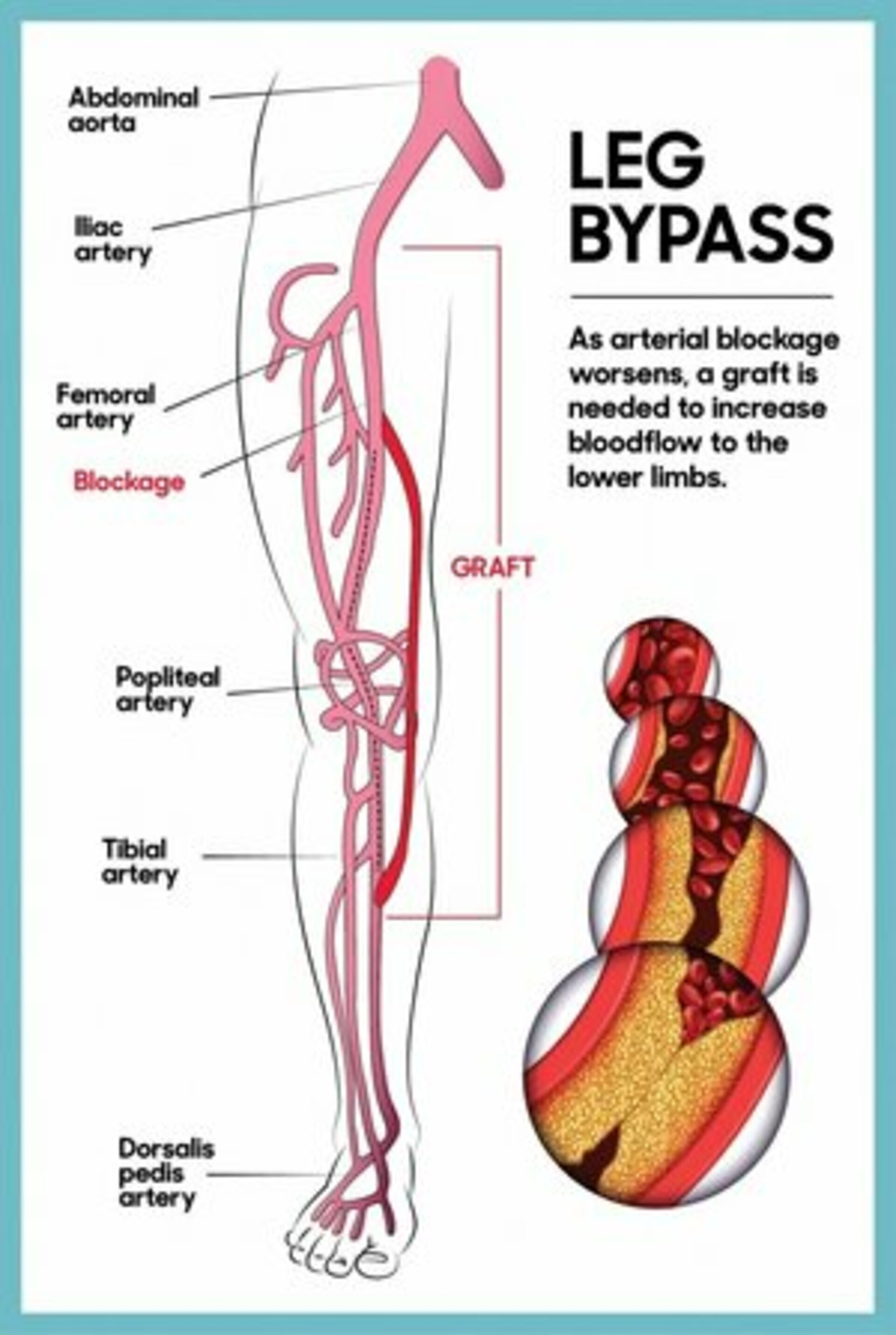 Leg bypass Surgery | Dr. Advait Kothurkar