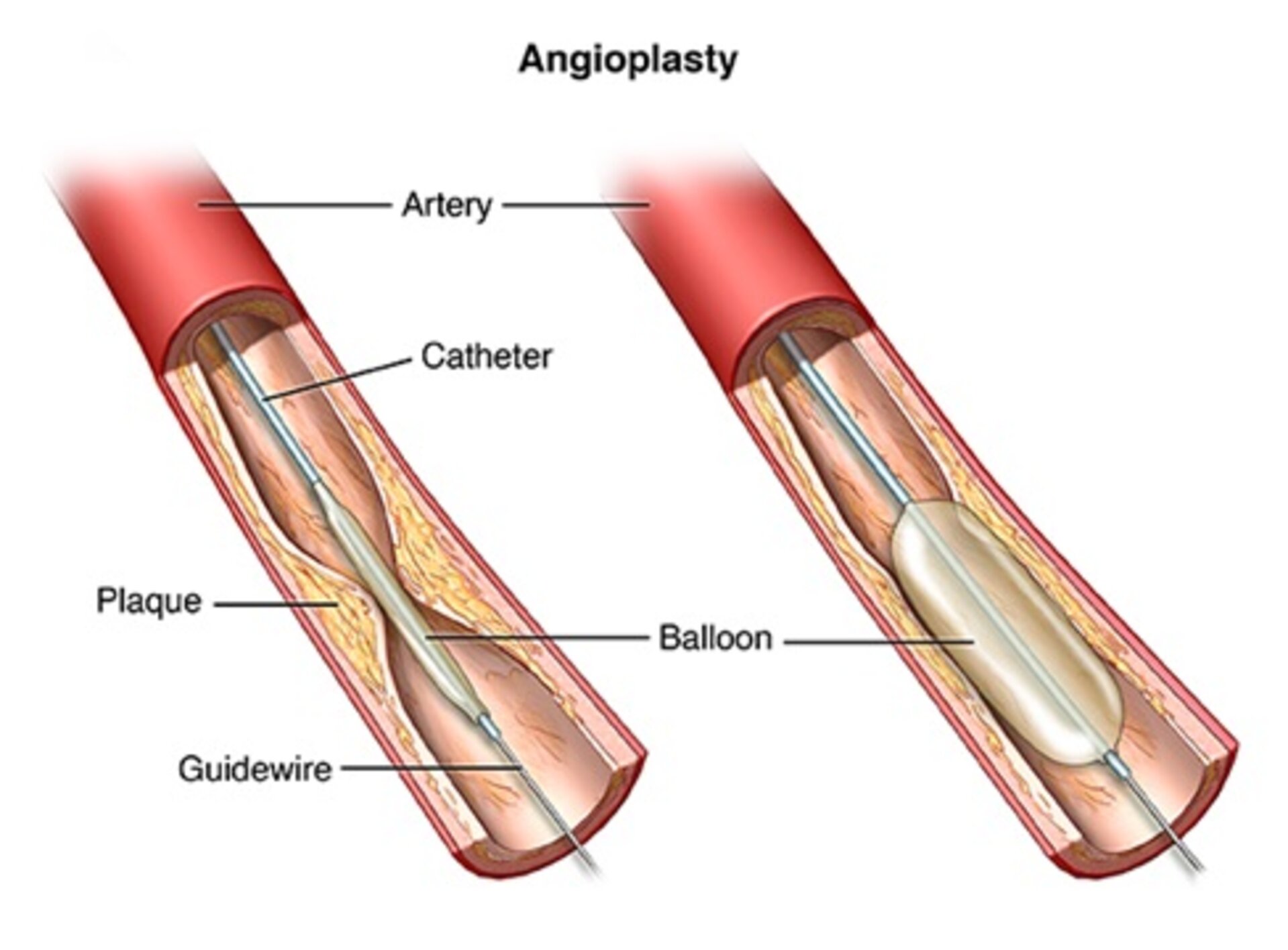 Angiography, Ballooning (Angioplasty) and Stenting | Dr. Advait Kothurkar