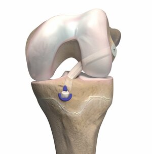 ACL Reconstruction