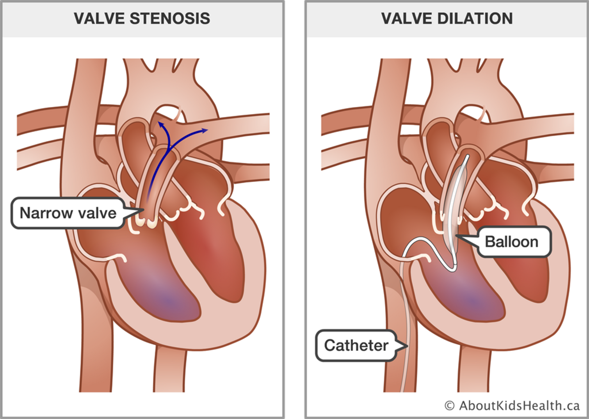 Balloon Valvuloplasty